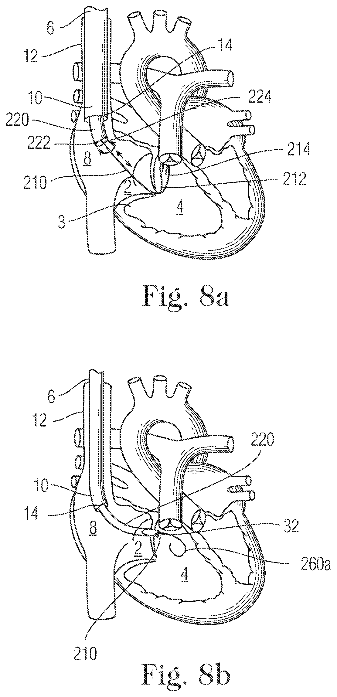 Patent US11793505 Figure 7 – Devices and methods for percutaneous tricuspid valve repair