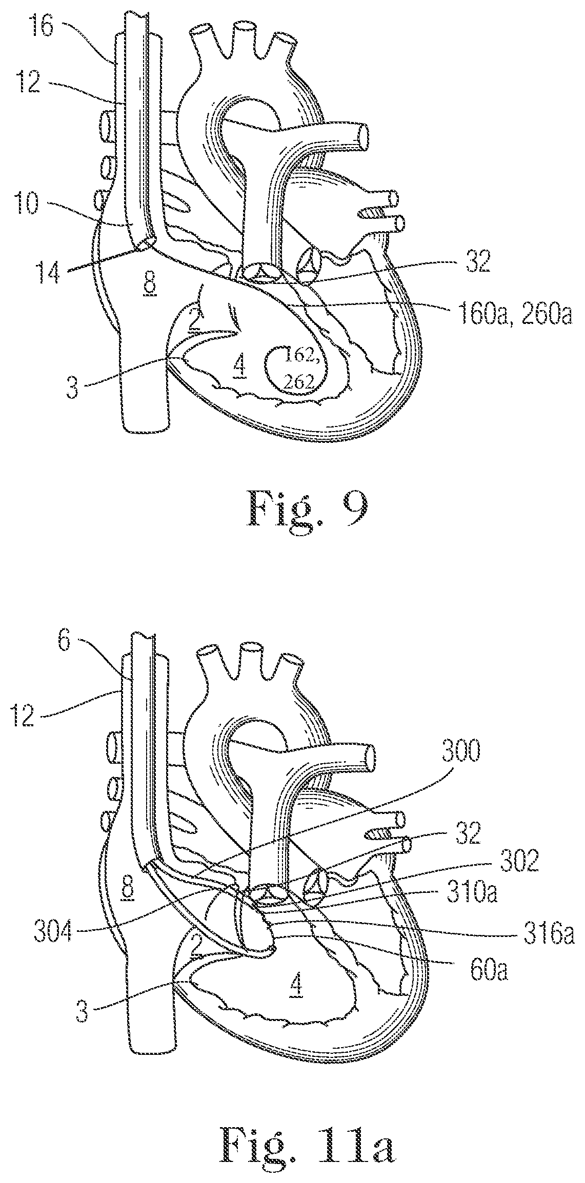Patent US11793505 Figure 8 – Devices and methods for percutaneous tricuspid valve repair
