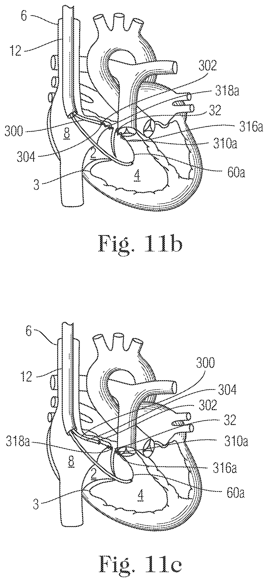 Patent US11793505 Figure 10 – Devices and methods for percutaneous tricuspid valve repair
