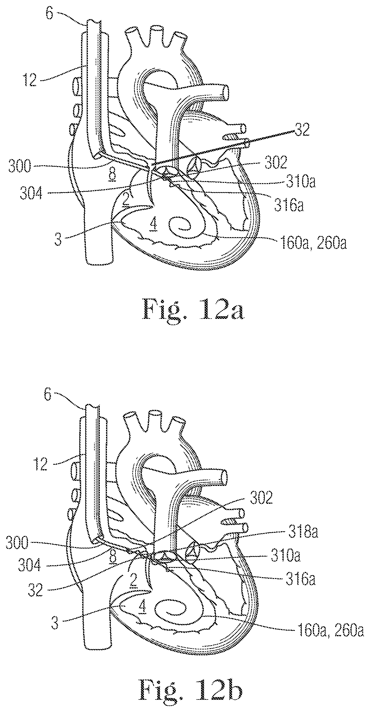 Patent US11793505 Figure 11 – Devices and methods for percutaneous tricuspid valve repair