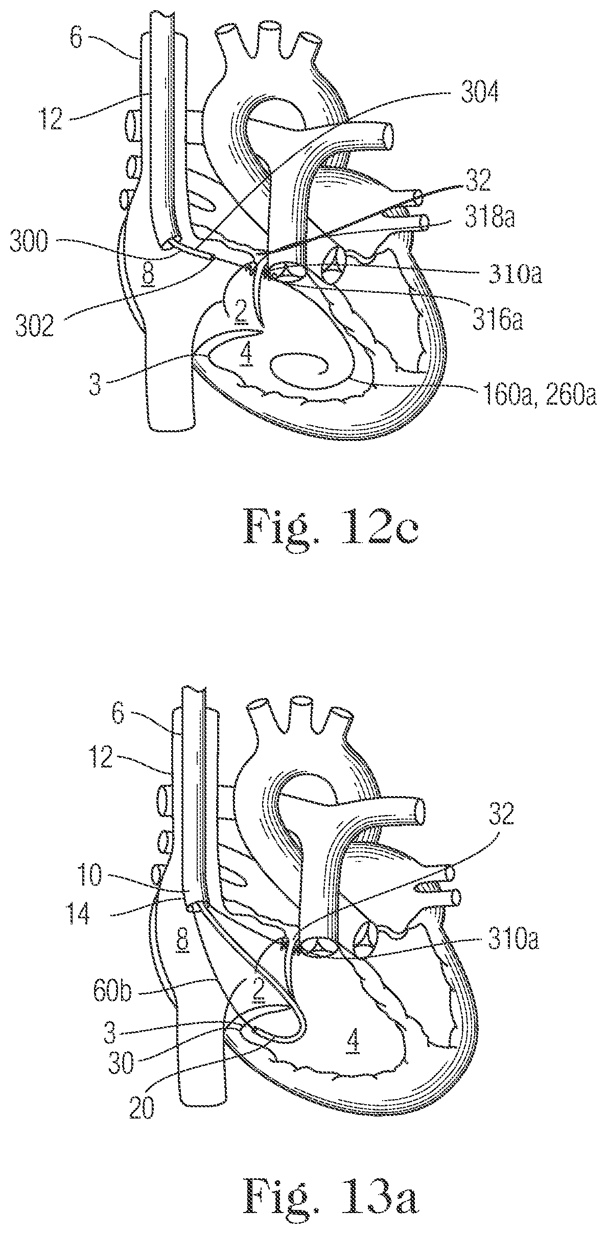 Patent US11793505 Figure 12 – Devices and methods for percutaneous tricuspid valve repair