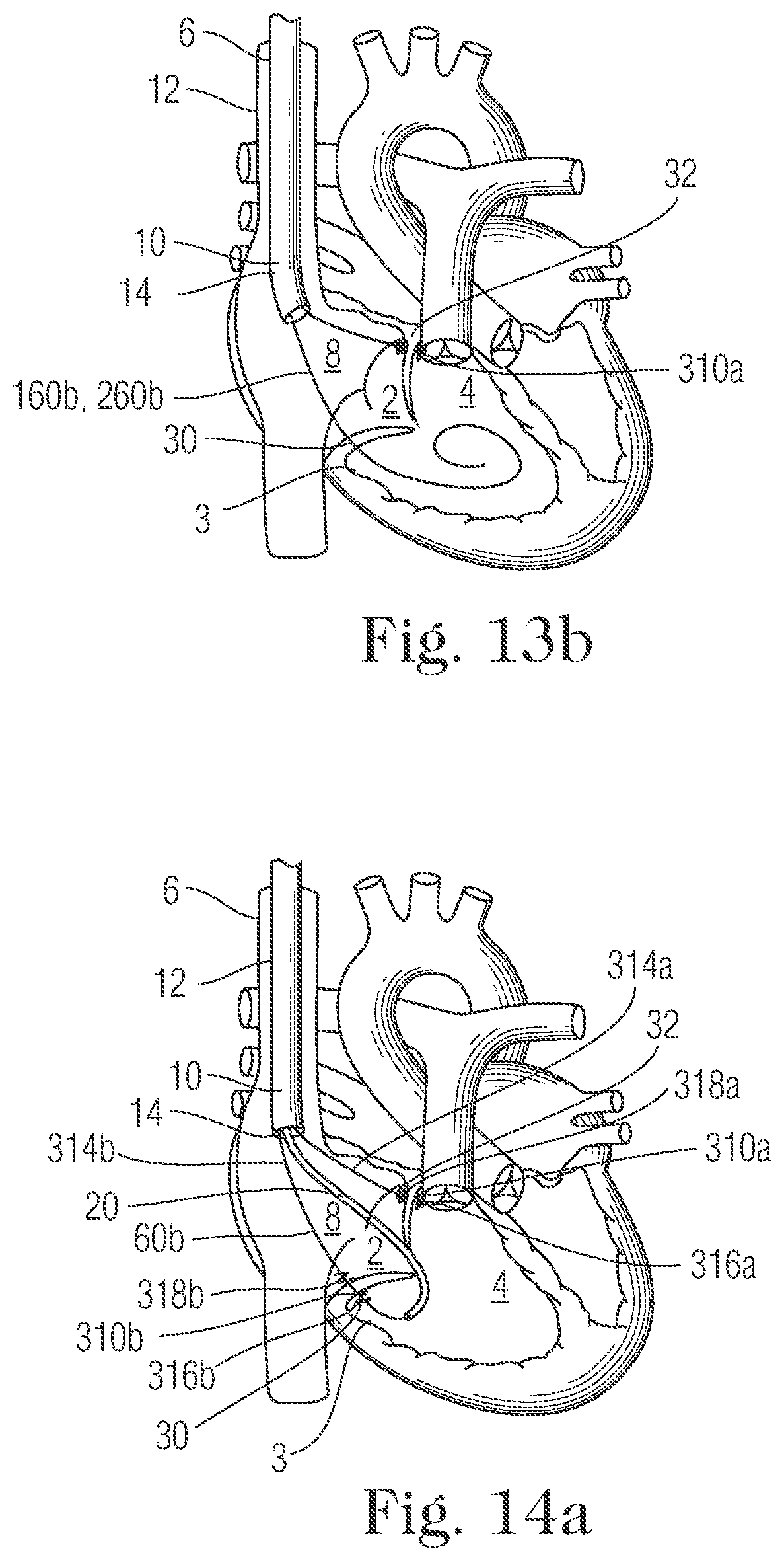 Patent US11793505 Figure 13 – Devices and methods for percutaneous tricuspid valve repair