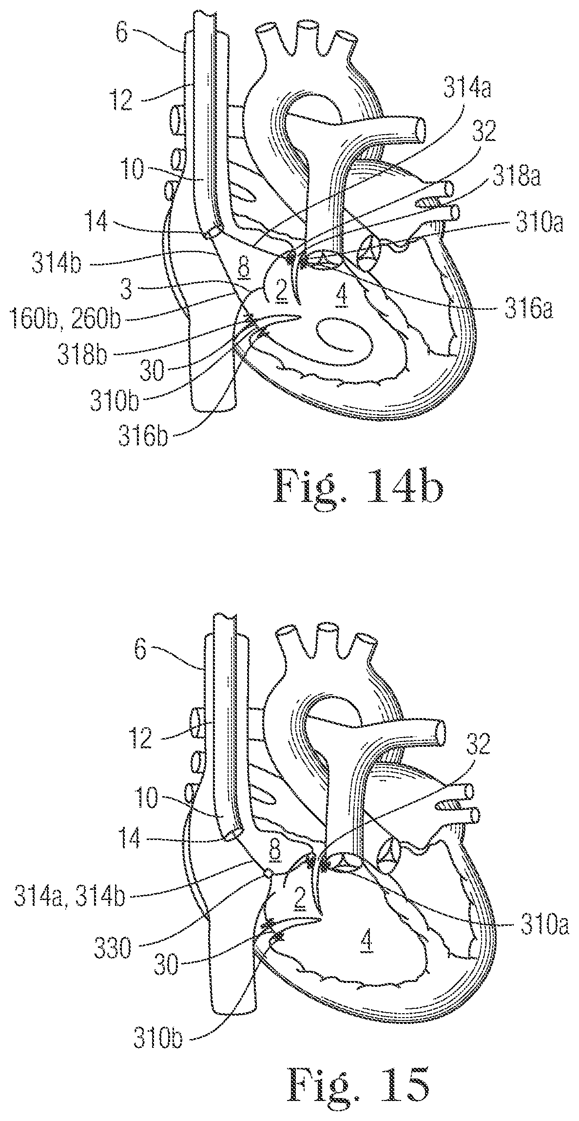 Patent US11793505 Figure 14 – Devices and methods for percutaneous tricuspid valve repair