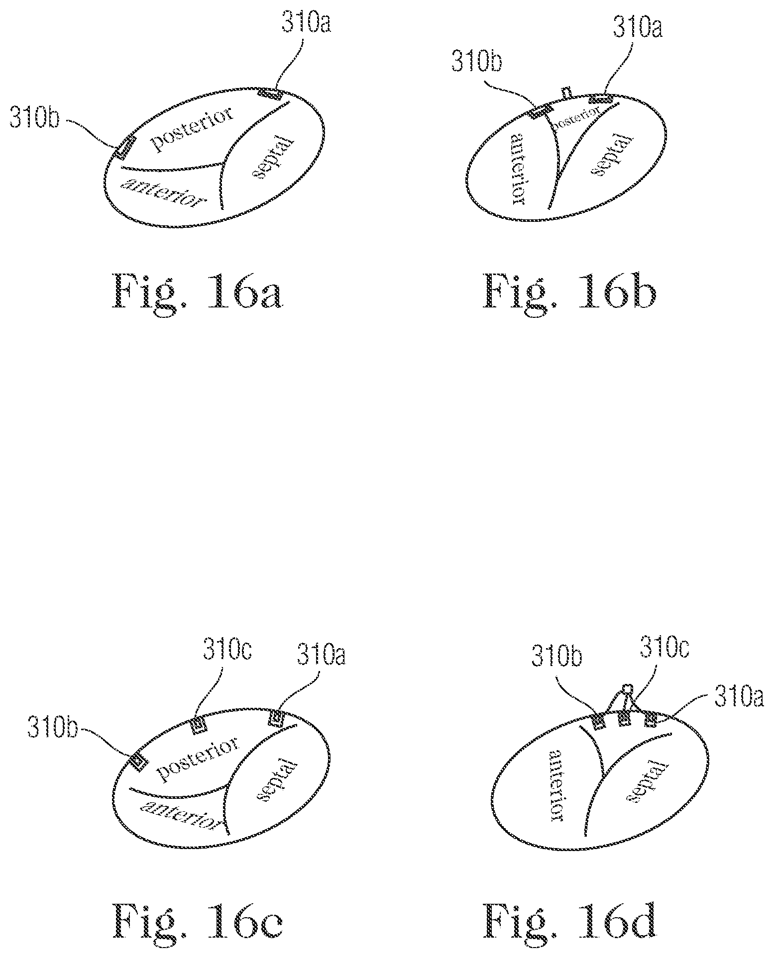 Patent US11793505 Figure 15 – Devices and methods for percutaneous tricuspid valve repair