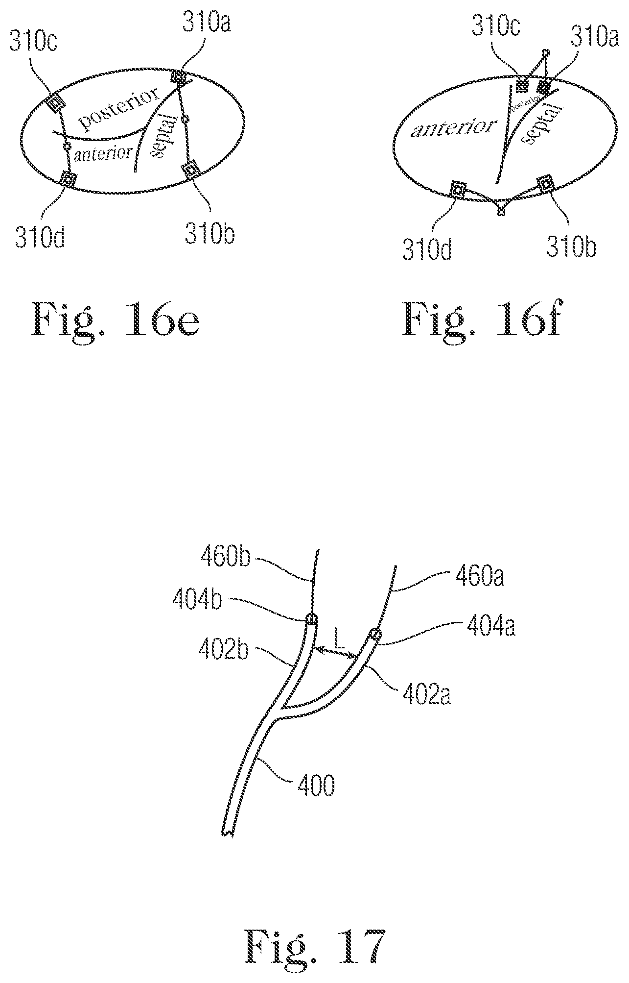 Patent US11793505 Figure 16 – Devices and methods for percutaneous tricuspid valve repair