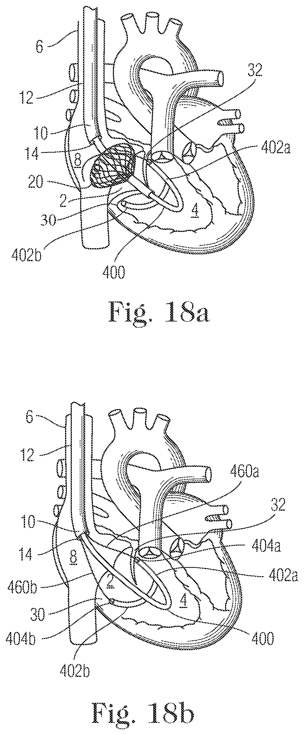Patent US11793505 Figure 17 – Devices and methods for percutaneous tricuspid valve repair
