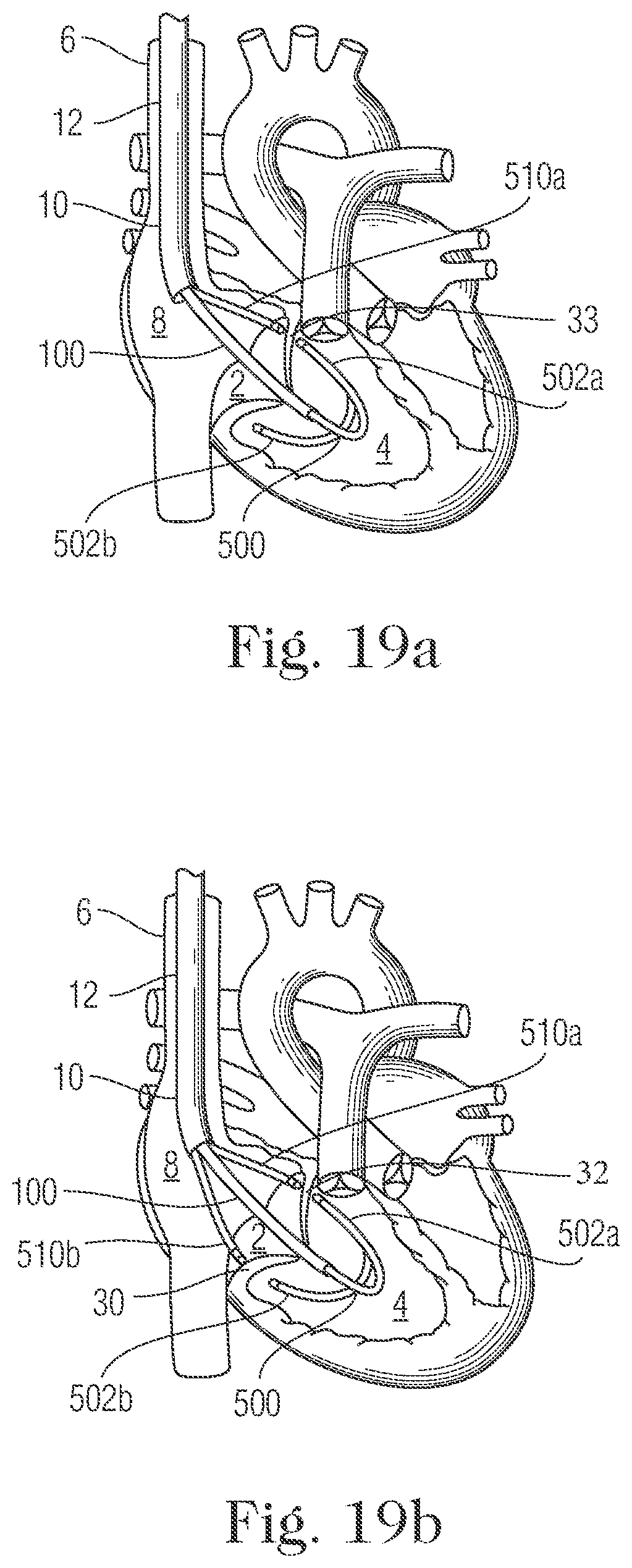Patent US11793505 Figure 18 – Devices and methods for percutaneous tricuspid valve repair