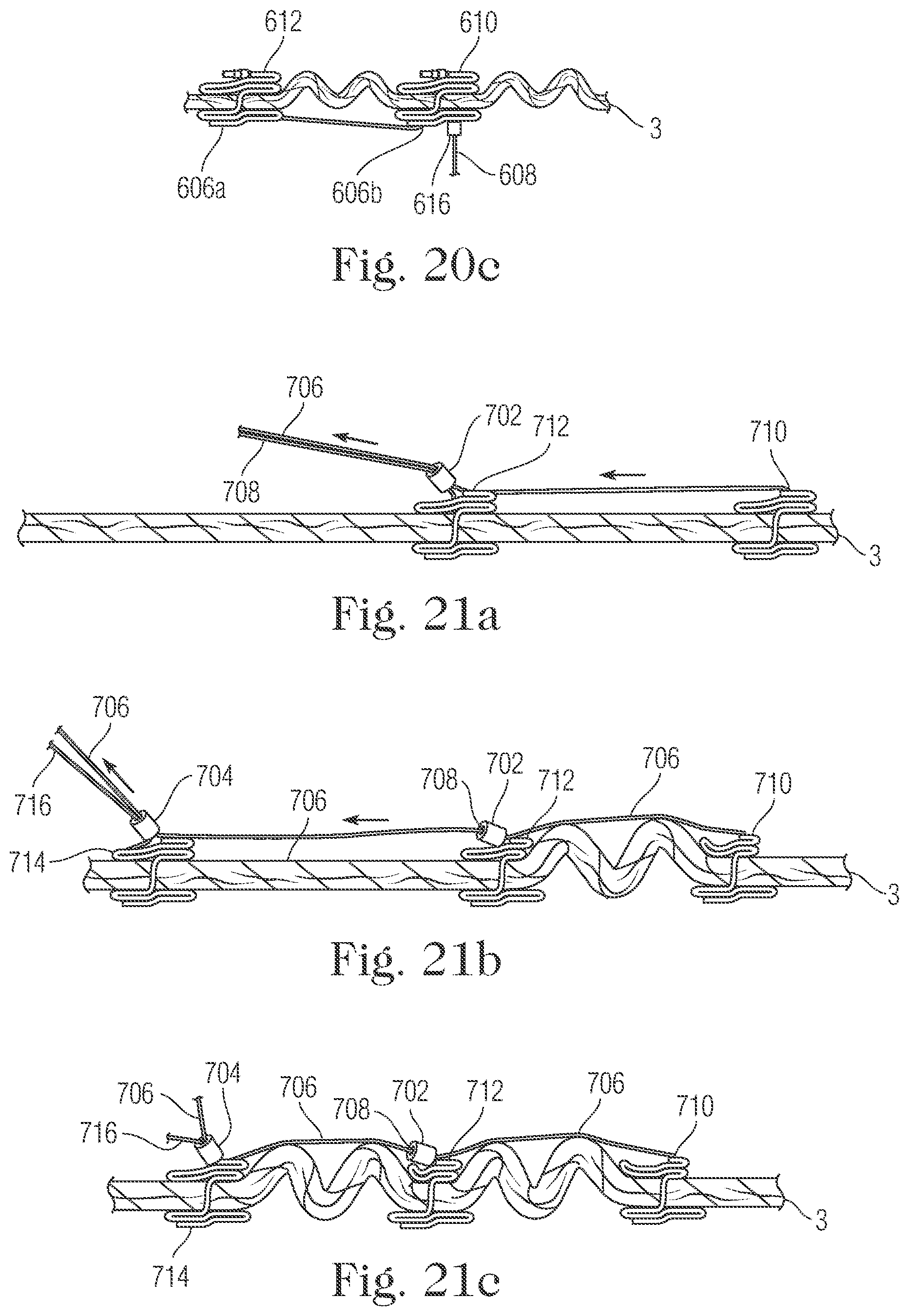 Patent US11793505 Figure 20 – Devices and methods for percutaneous tricuspid valve repair