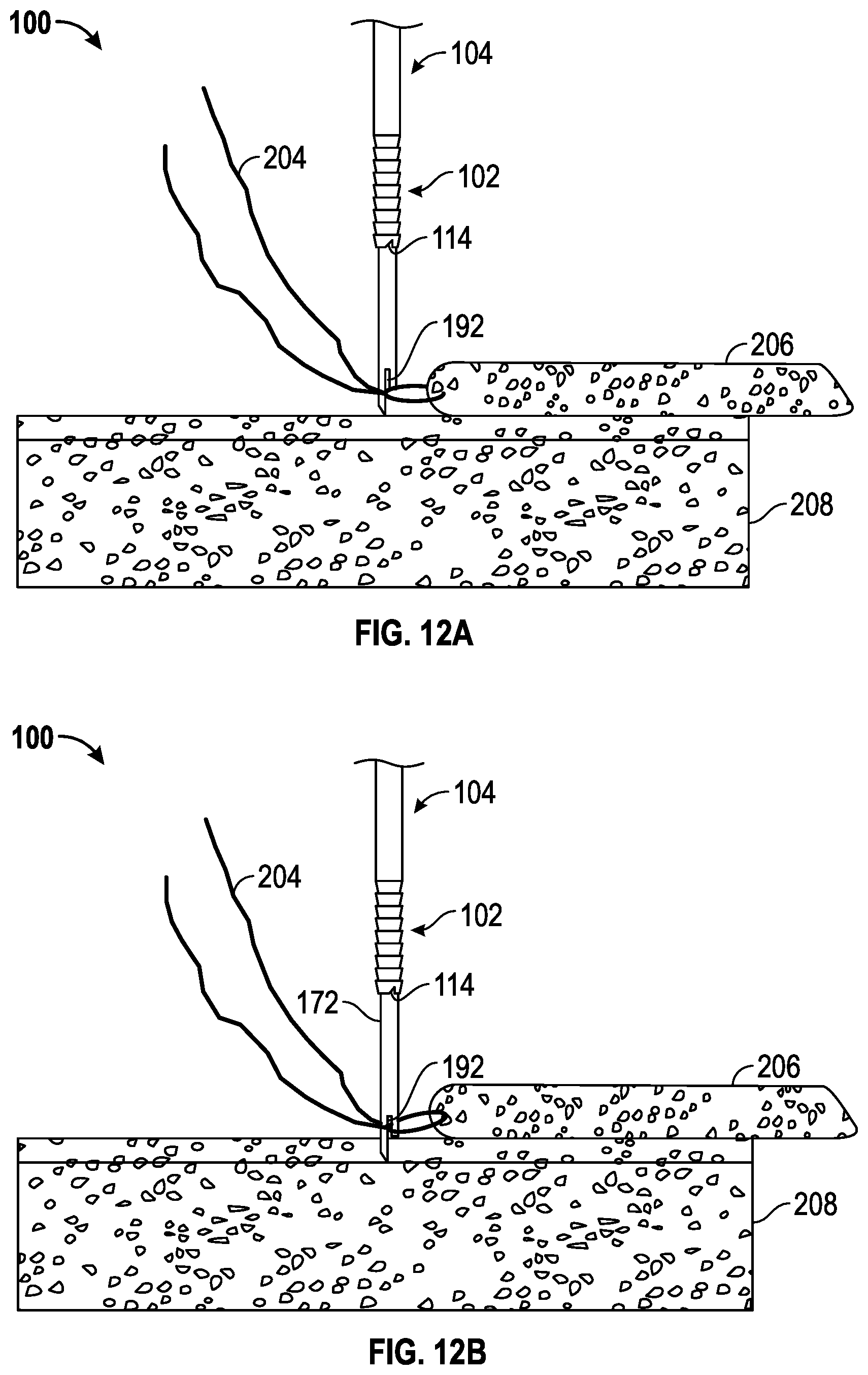 Patent US11793506 Figure 9 – Suture anchor system and method