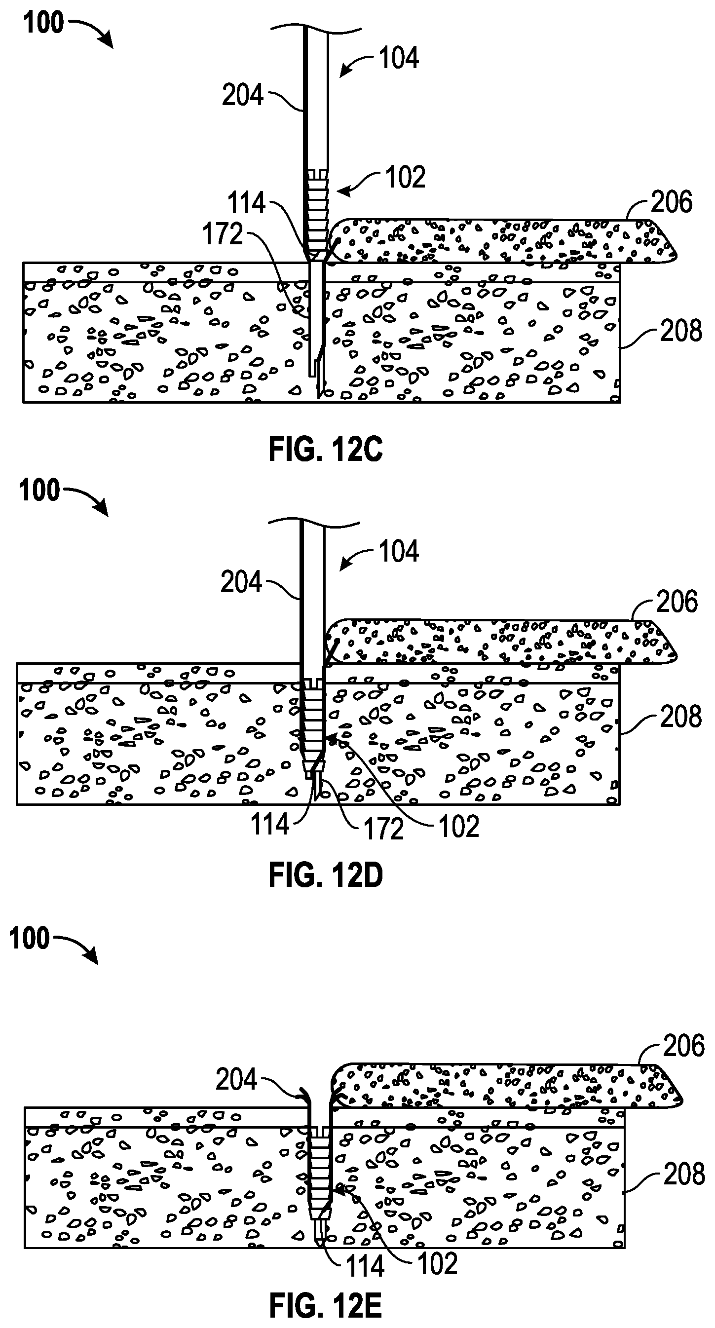 Patent US11793506 Figure 10 – Suture anchor system and method