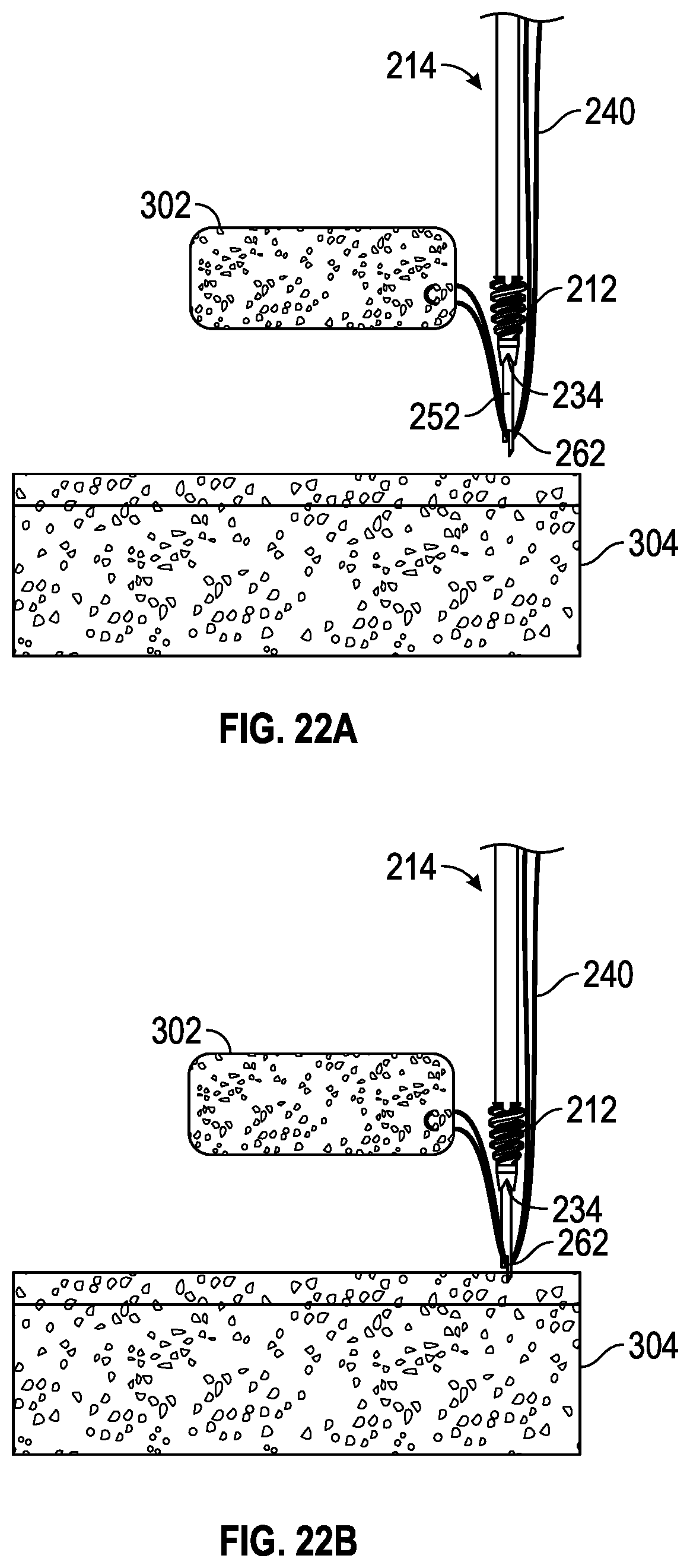 Patent US11793506 Figure 17 – Suture anchor system and method