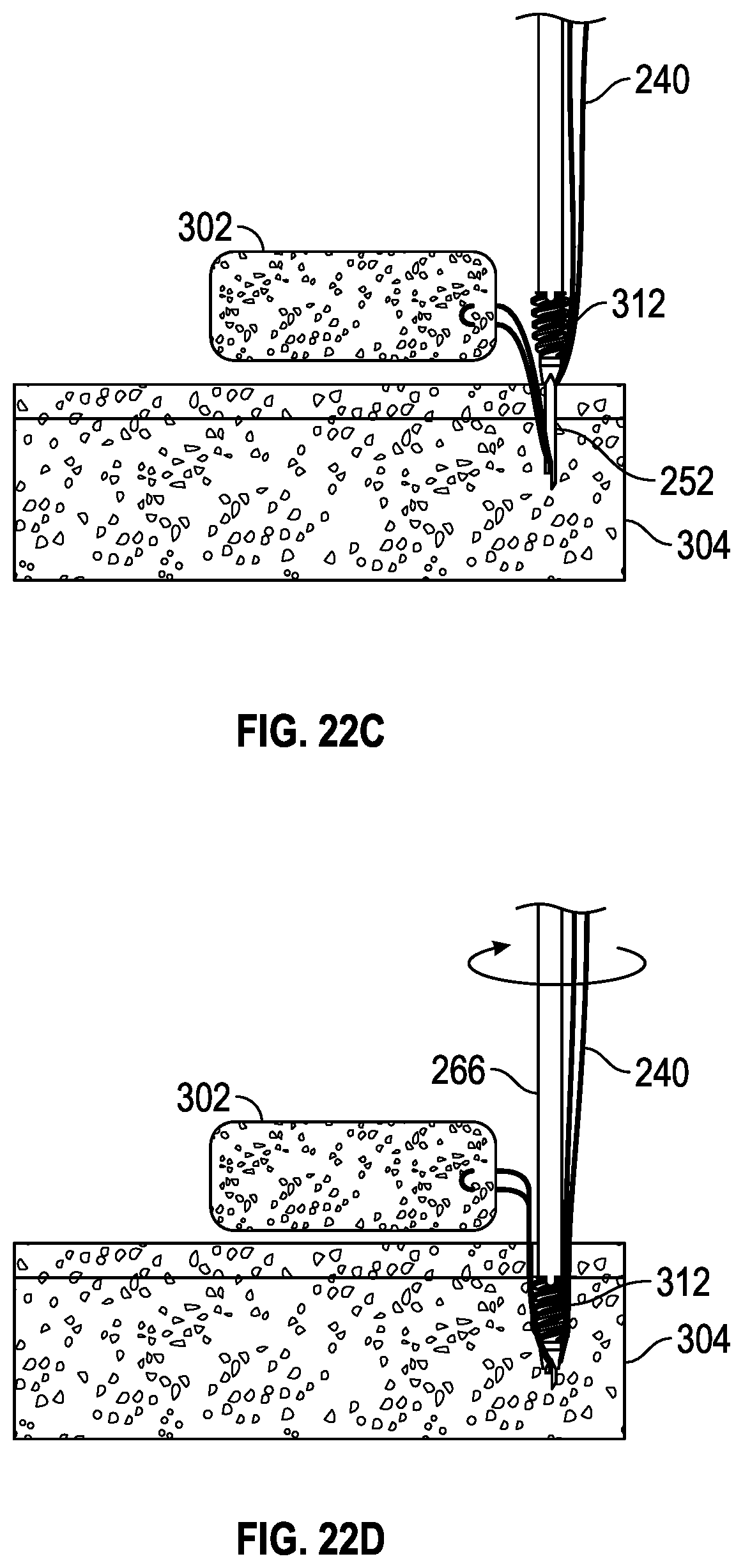 Patent US11793506 Figure 18 – Suture anchor system and method