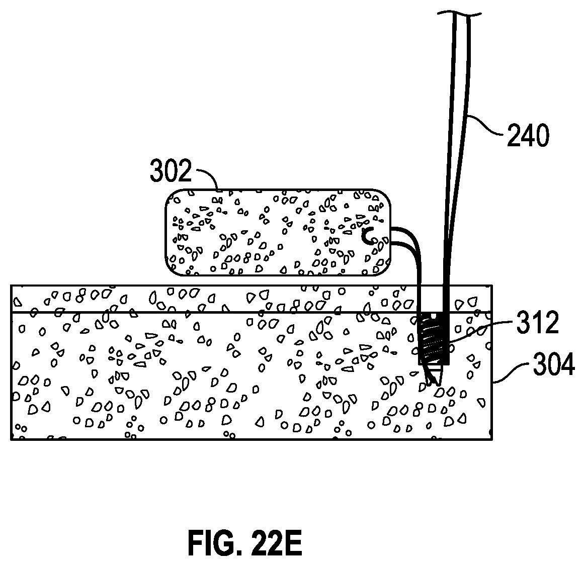 Patent US11793506 Figure 19 – Suture anchor system and method