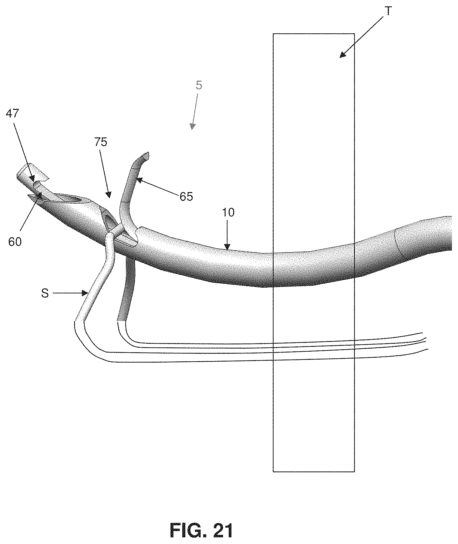 Patent US11793507 Figure 20 – Method and apparatus for passing suture through tissue