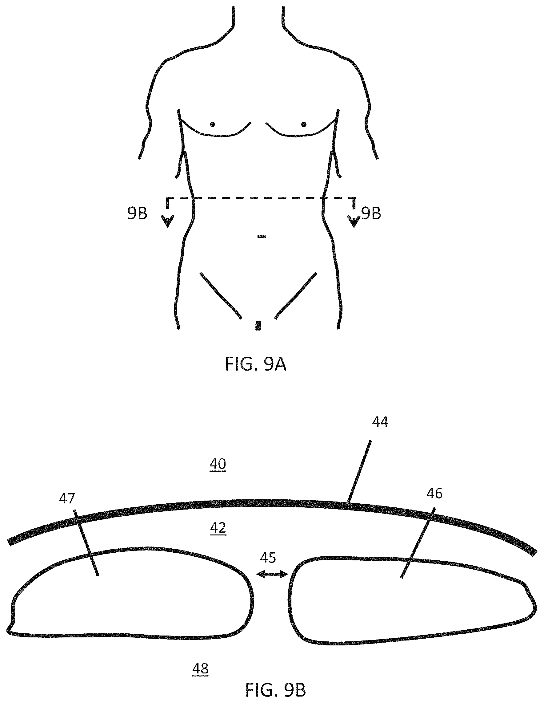 Patent US11793508 Figure 7 – Systems, devices and methods for tissue fixation and approximating tissue defects