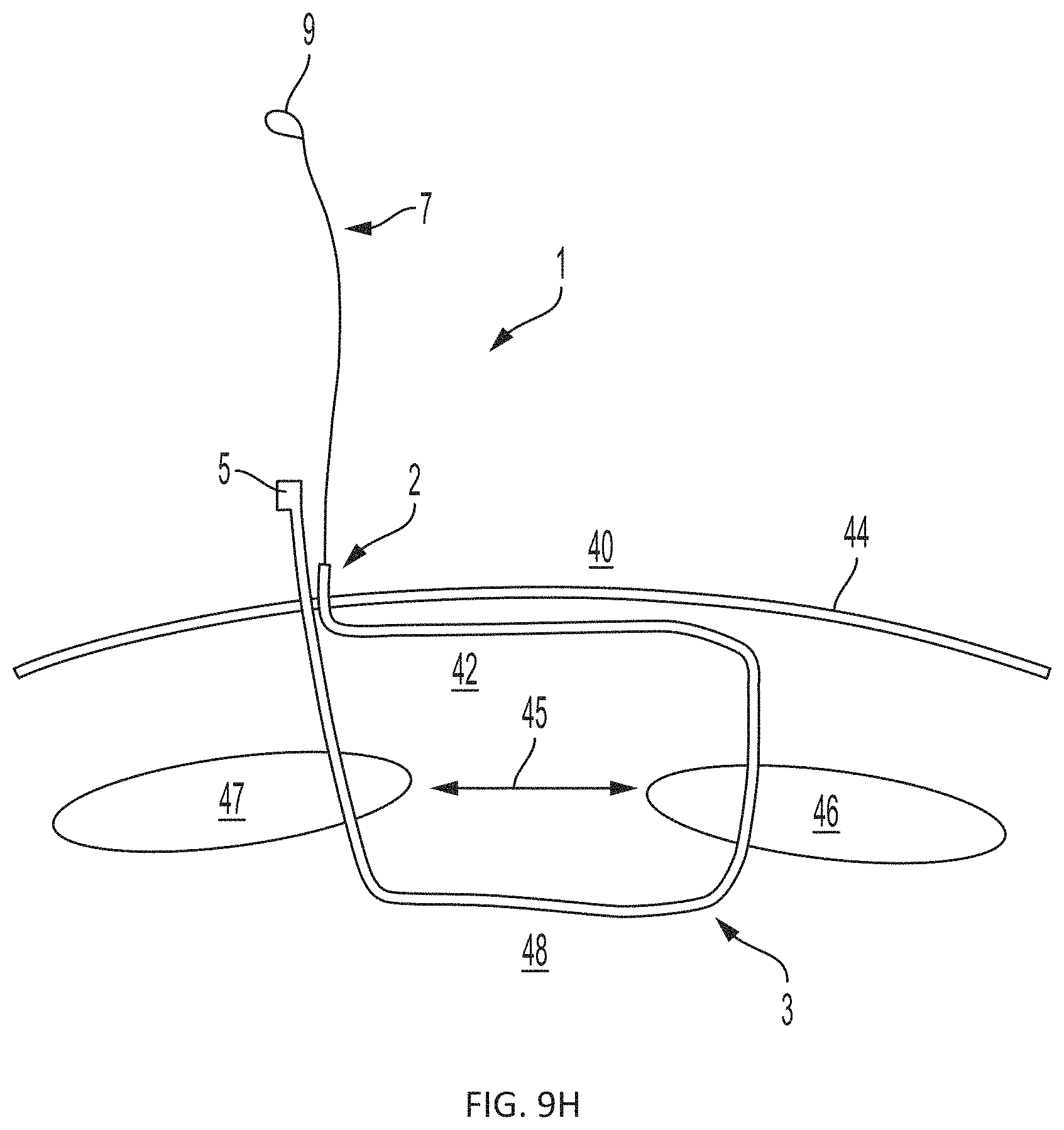 Patent US11793508 Figure 12 – Systems, devices and methods for tissue fixation and approximating tissue defects