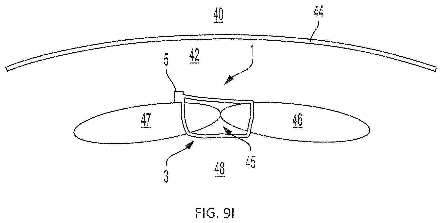 Patent US11793508 Figure 13 – Systems, devices and methods for tissue fixation and approximating tissue defects