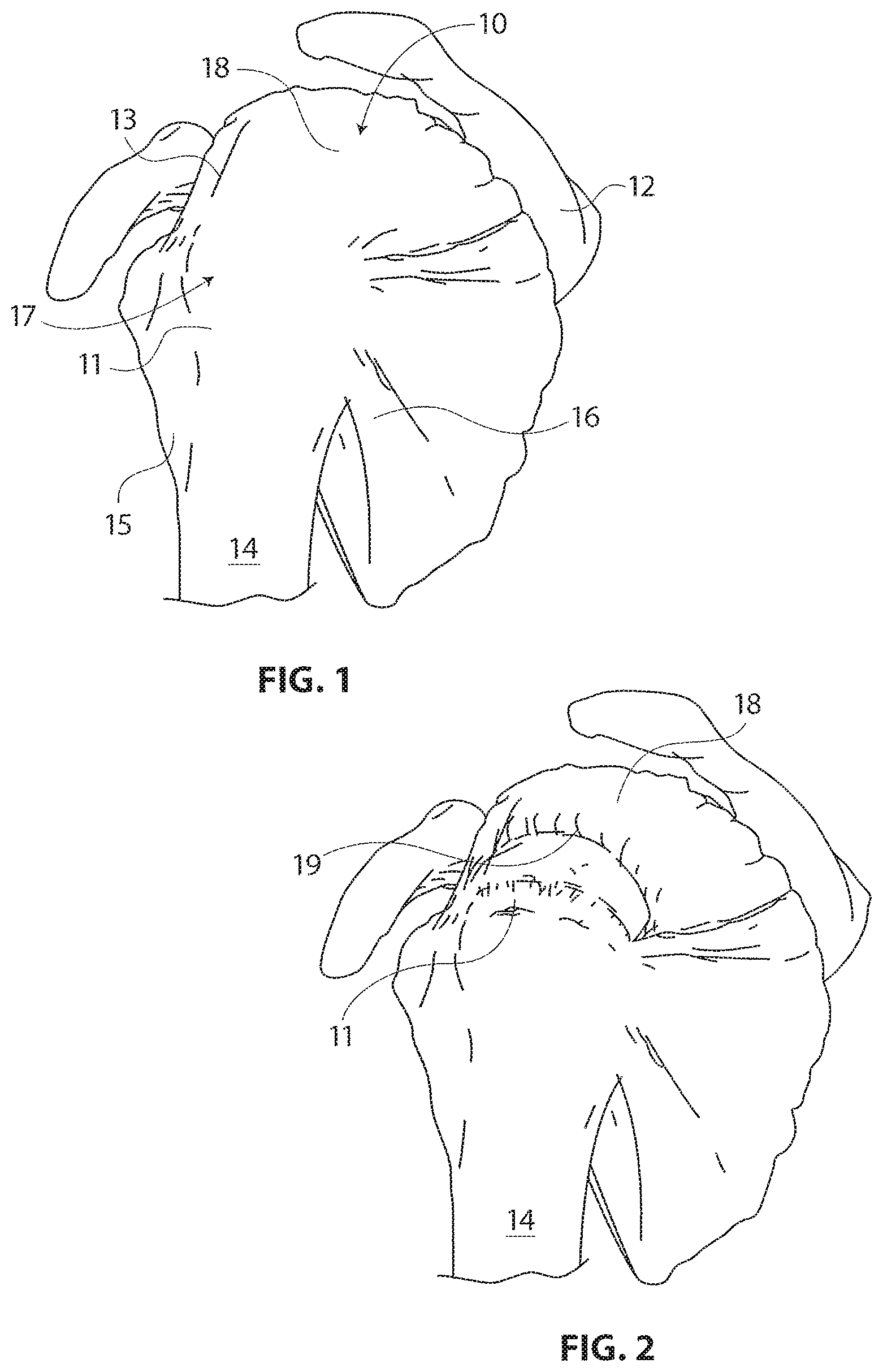 Patent US11793510 Figure 1 – Methods and apparatus for delivering staples to a target tissue