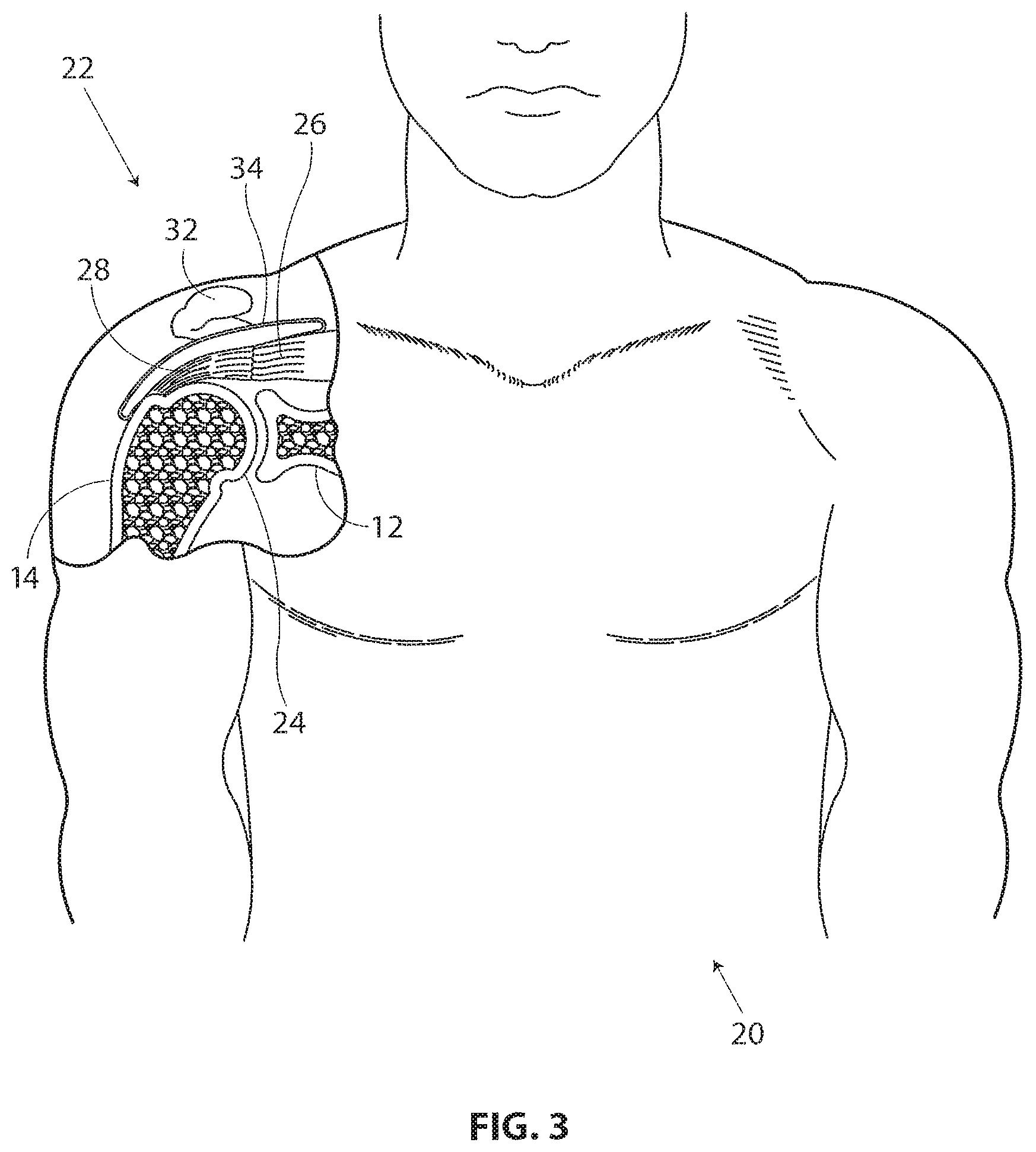 Patent US11793510 Figure 2 – Methods and apparatus for delivering staples to a target tissue