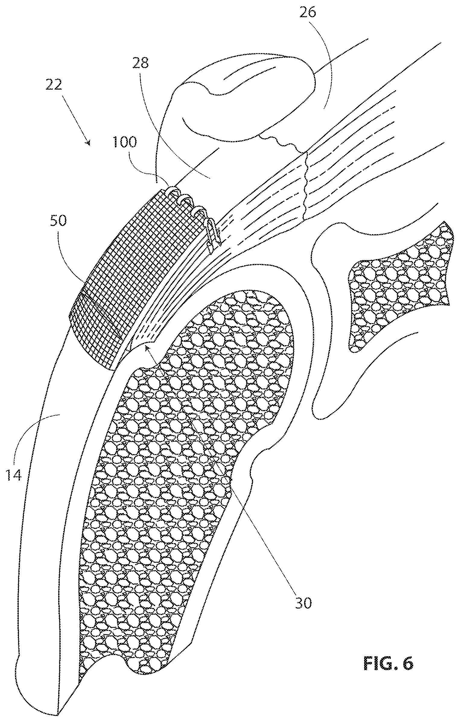 Patent US11793510 Figure 5 – Methods and apparatus for delivering staples to a target tissue