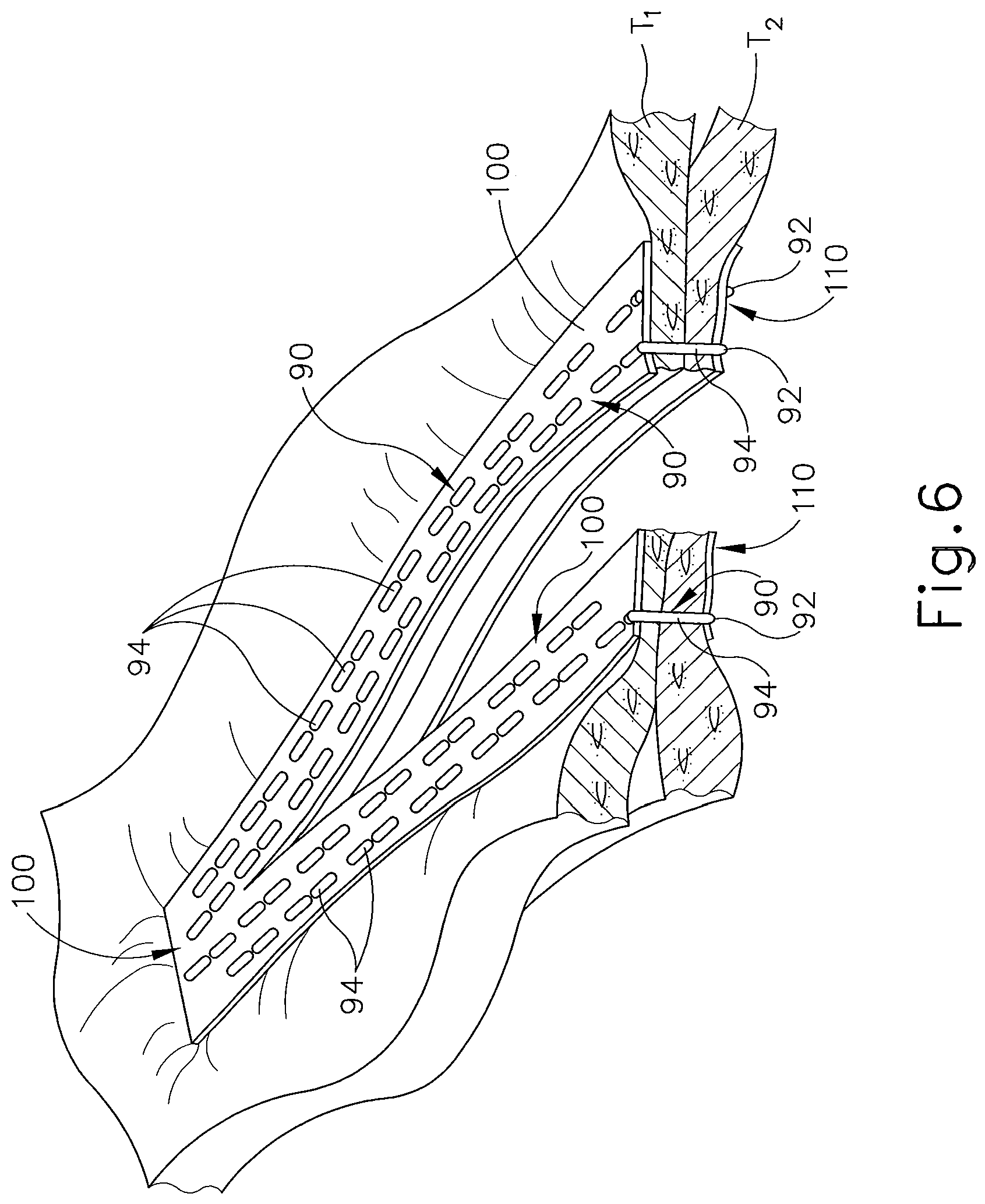 Patent US11793515 Figure 6 – Surgical stapler buttress assembly with adhesion to wet end effector