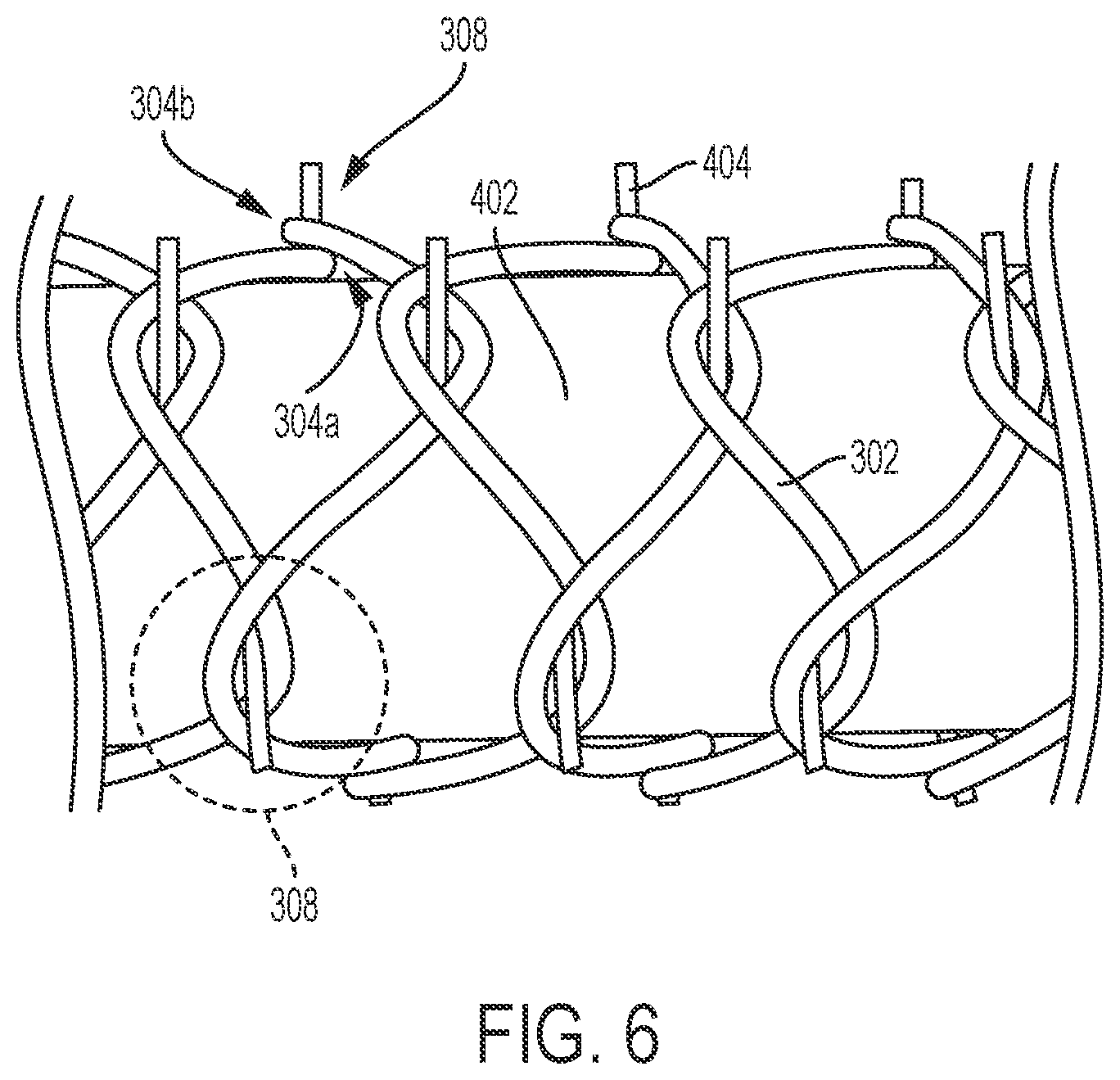 Patent US11793523 Figure 6 – Aneurysm treatment coils and associated systems and methods of use
