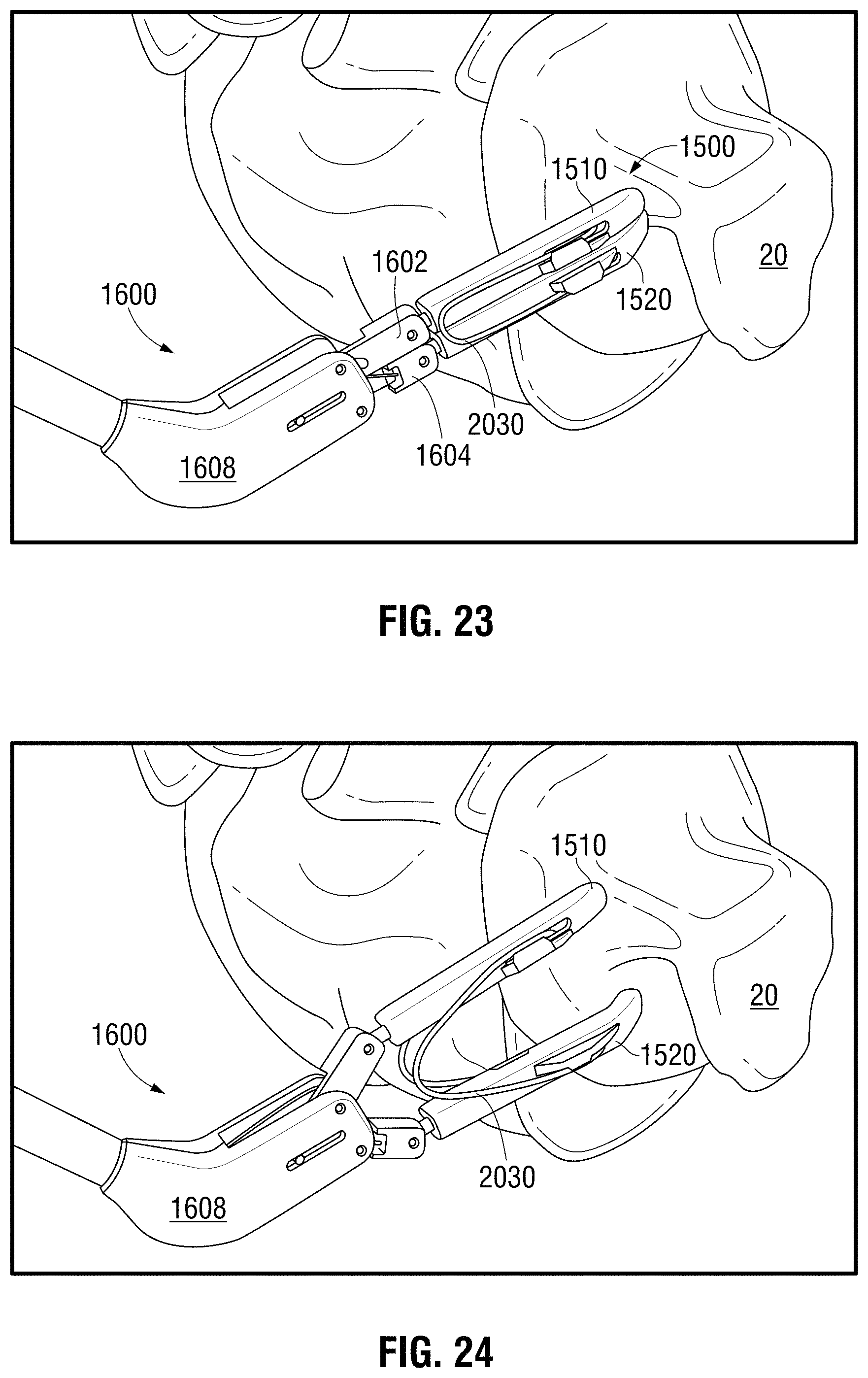 Patent US11793524 Figure 12 – Recapturable left atrial appendage clipping device and methods for recapturing a left atrial appendage clip