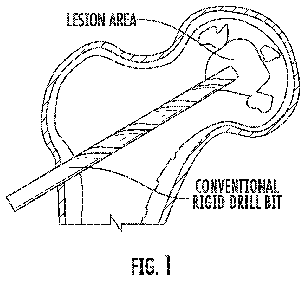 Patent US11793526 Figure 1 – Steerable drill for minimally-invasive surgery