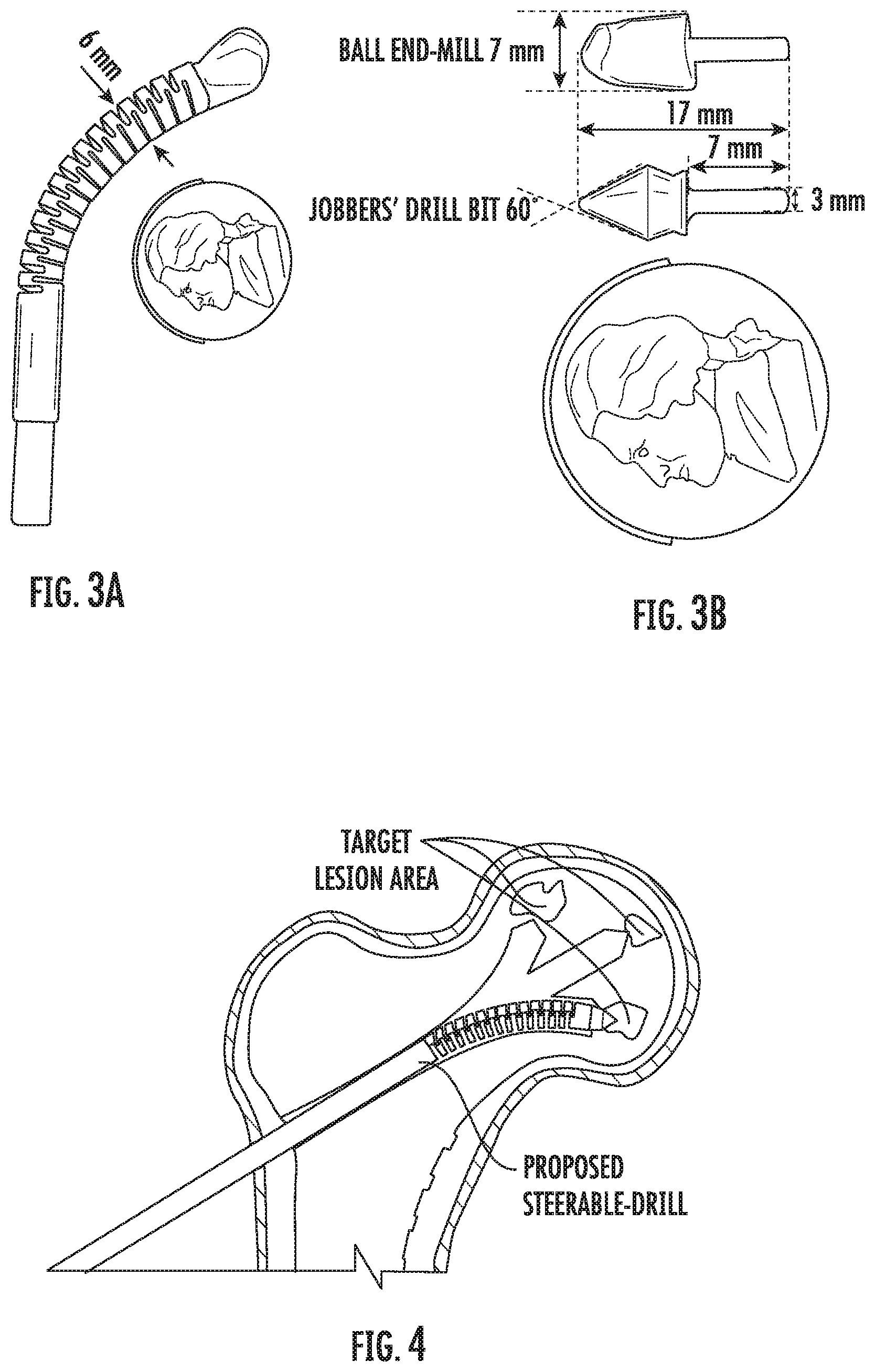 Patent US11793526 Figure 3 – Steerable drill for minimally-invasive surgery