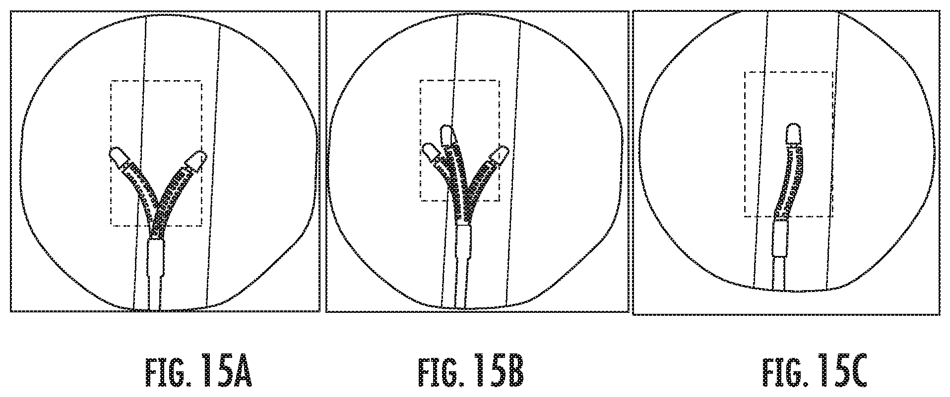Patent US11793526 Figure 11 – Steerable drill for minimally-invasive surgery