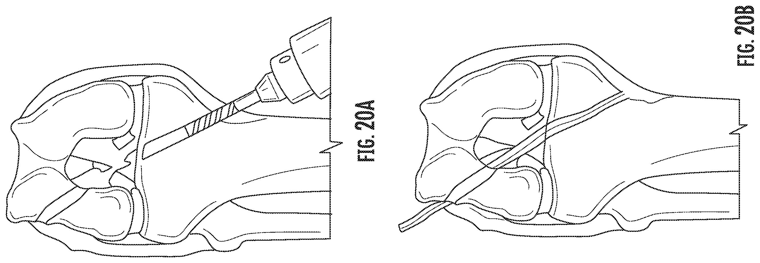 Patent US11793526 Figure 15 – Steerable drill for minimally-invasive surgery