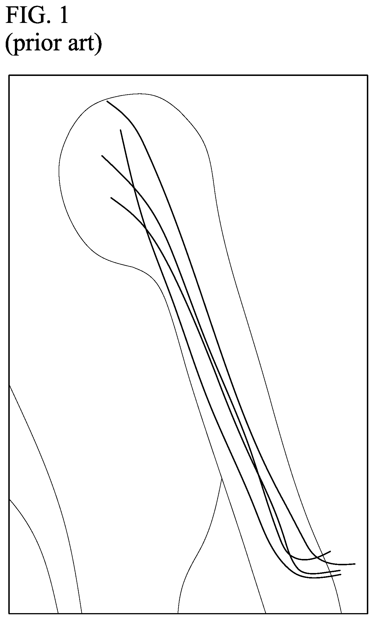 Patent US11793528 Figure 1 – Supracondylar fracture mending device