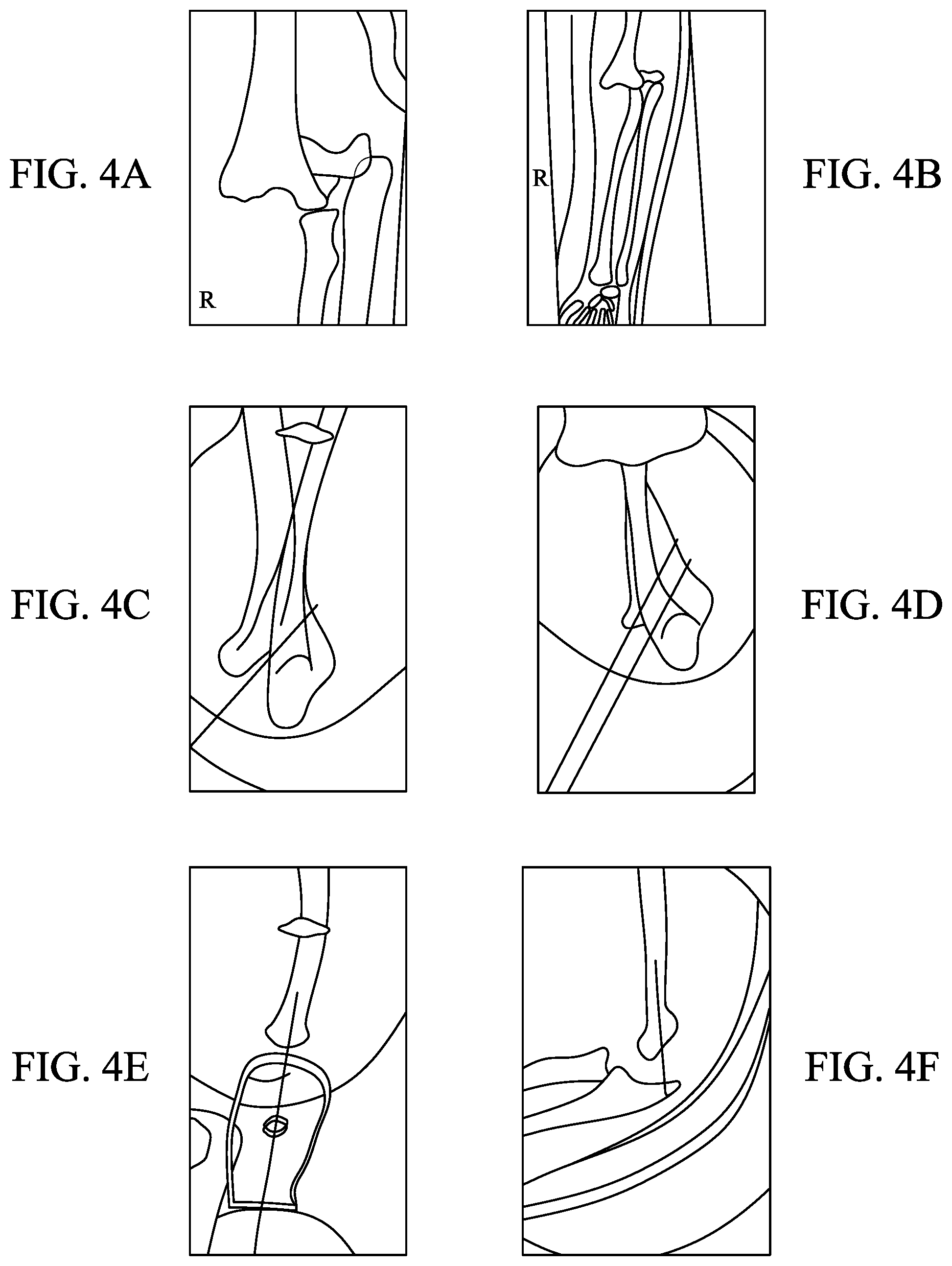 Patent US11793528 Figure 7 – Supracondylar fracture mending device