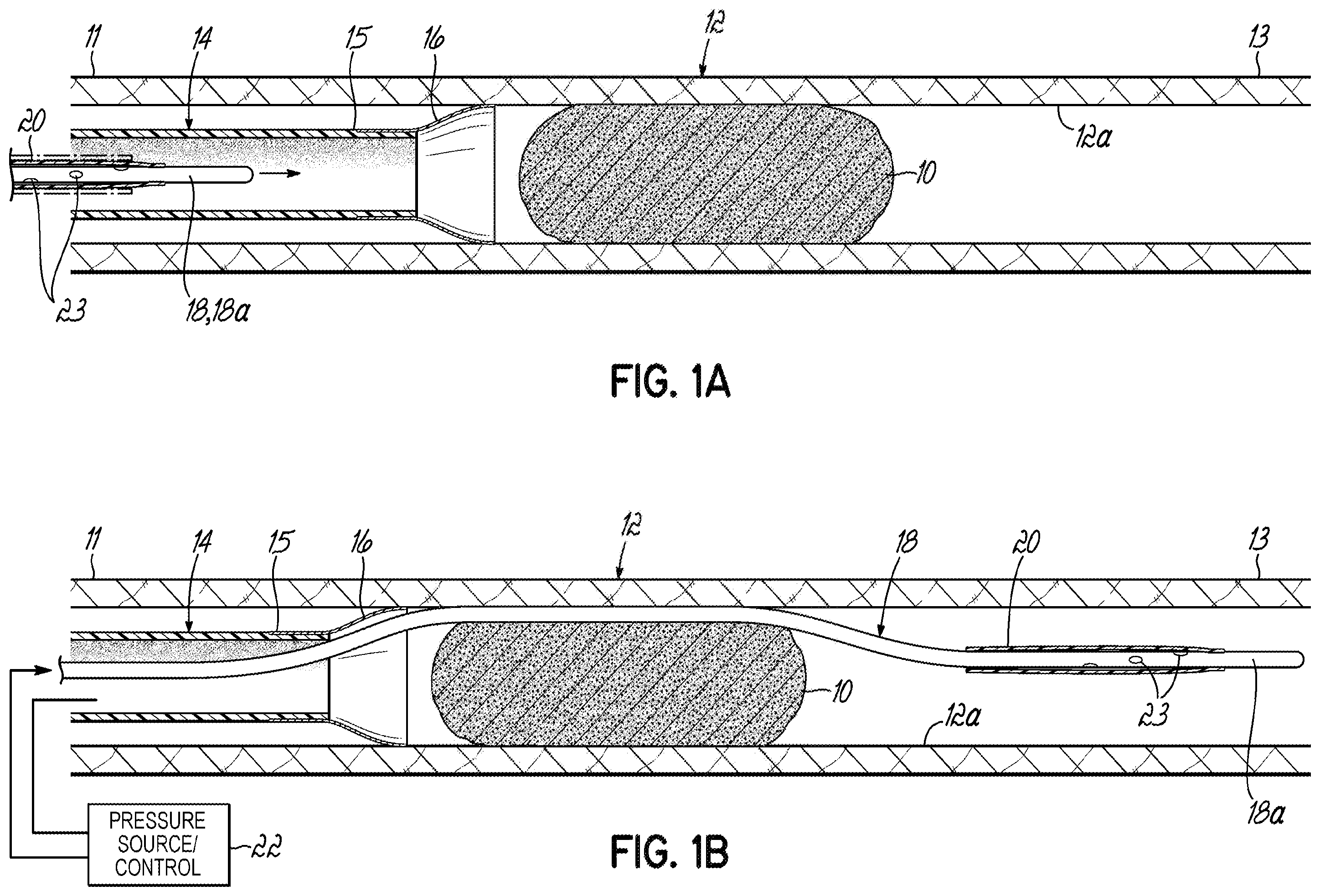 Patent US11793532 Figure 1 – Devices, systems and methods to remove blood clots