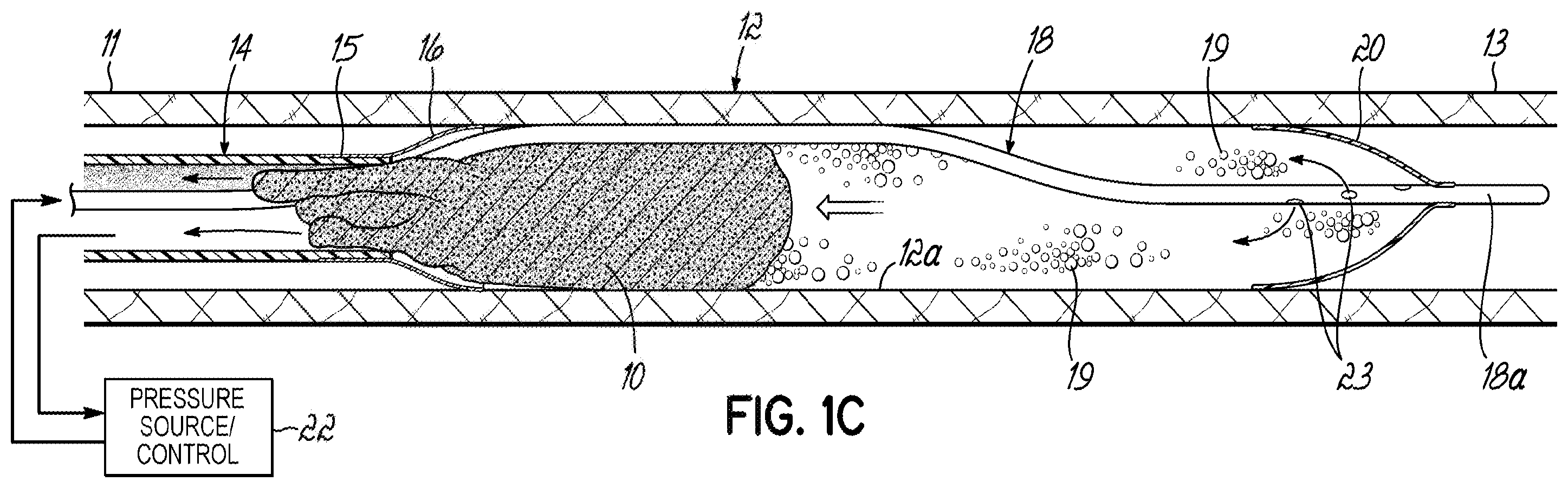Patent US11793532 Figure 2 – Devices, systems and methods to remove blood clots