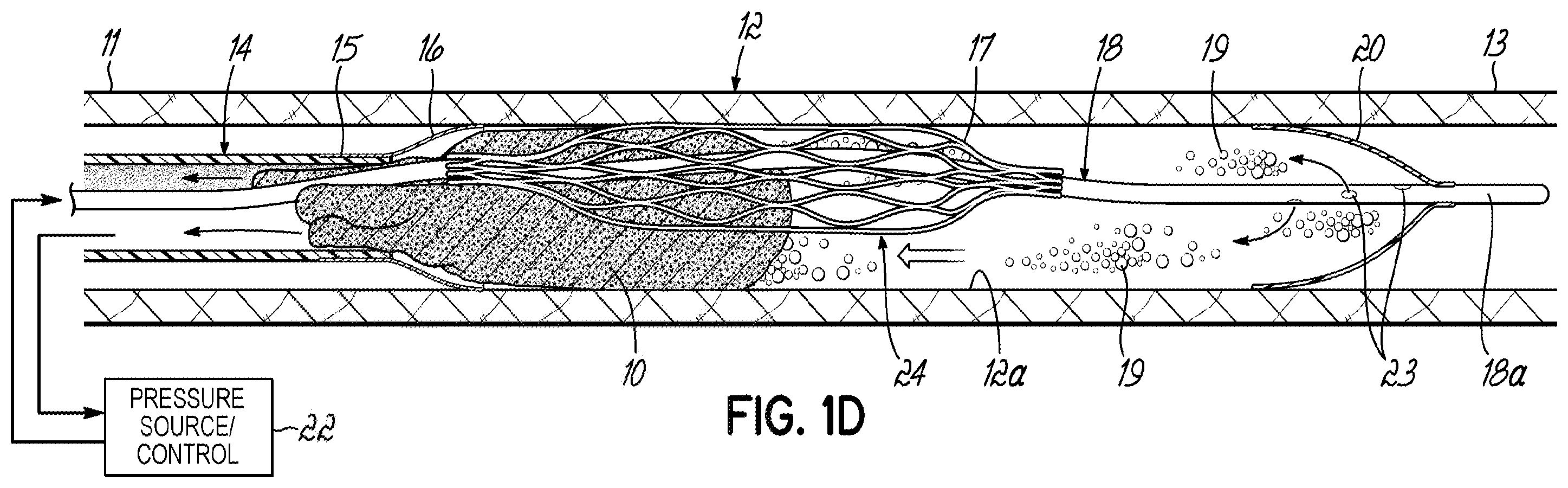 Patent US11793532 Figure 3 – Devices, systems and methods to remove blood clots