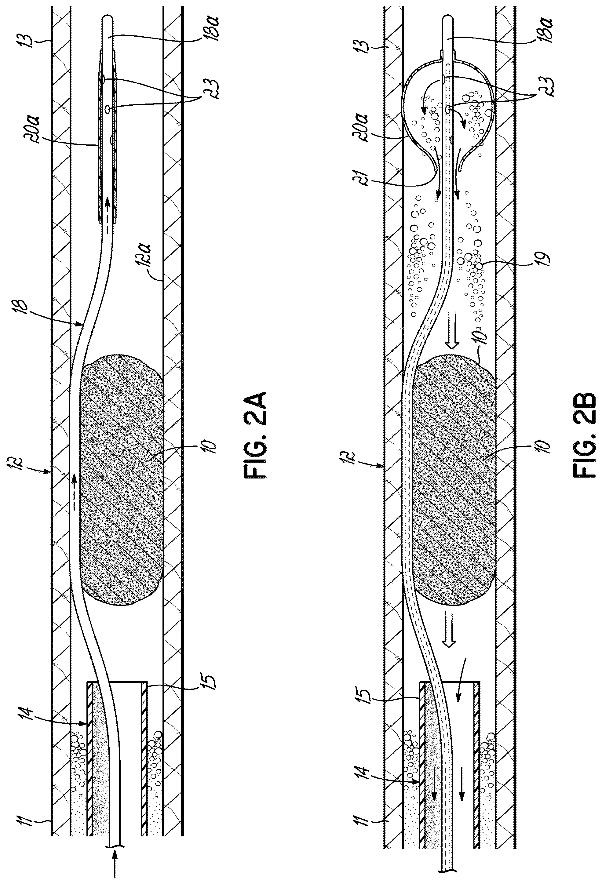 Patent US11793532 Figure 4 – Devices, systems and methods to remove blood clots