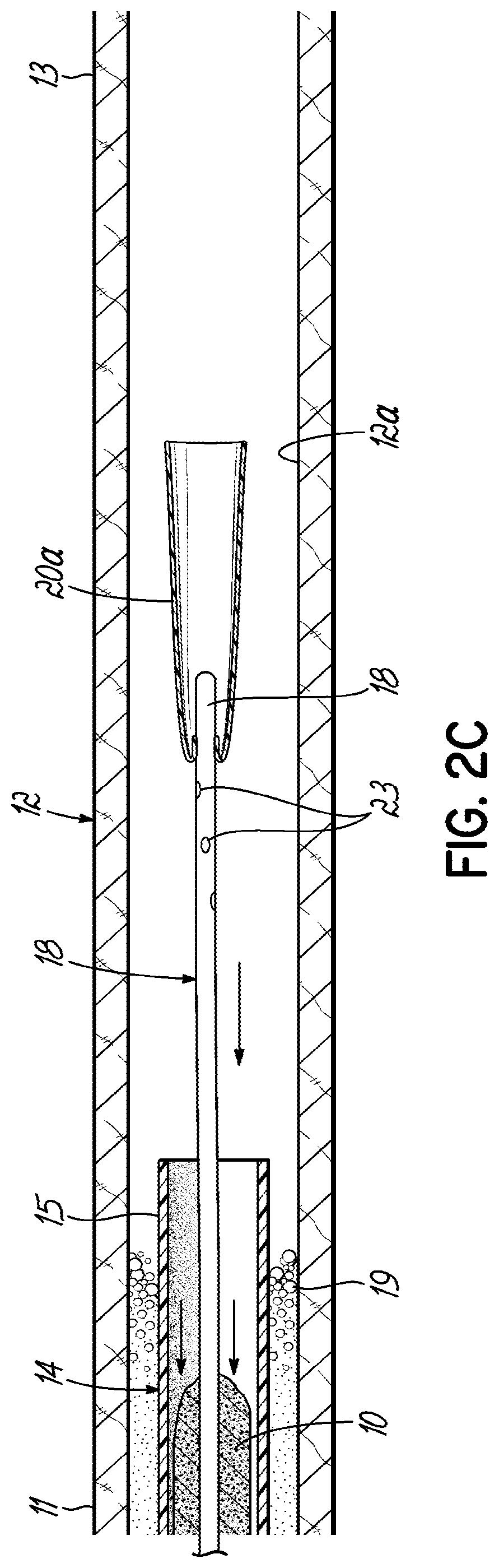 Patent US11793532 Figure 5 – Devices, systems and methods to remove blood clots