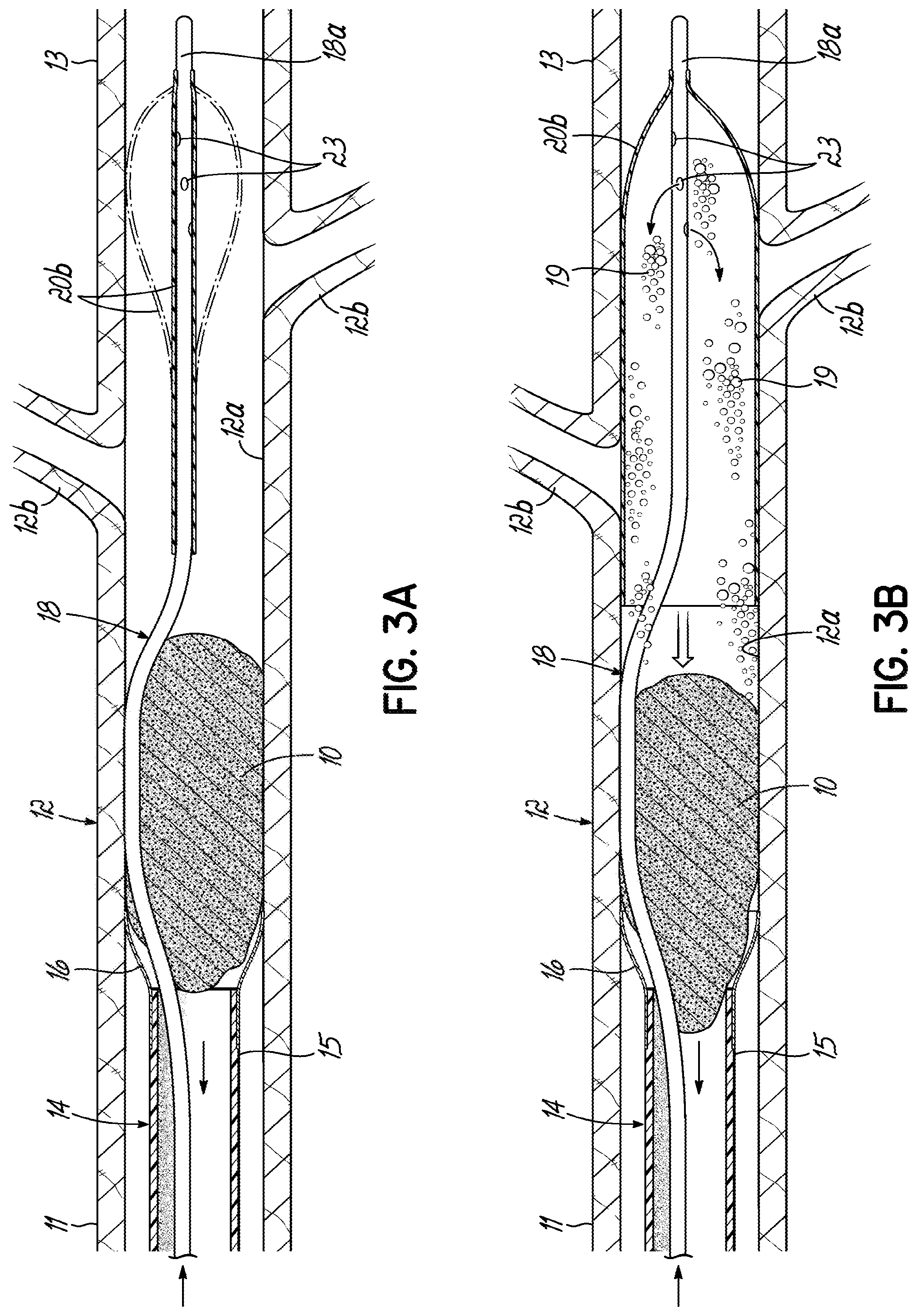 Patent US11793532 Figure 6 – Devices, systems and methods to remove blood clots
