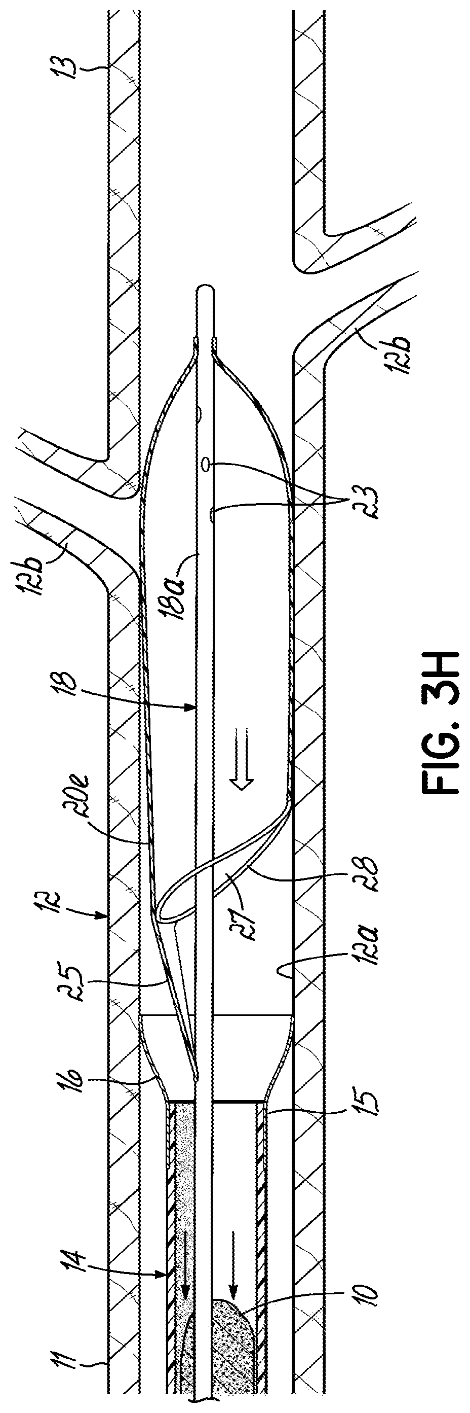 Patent US11793532 Figure 10 – Devices, systems and methods to remove blood clots
