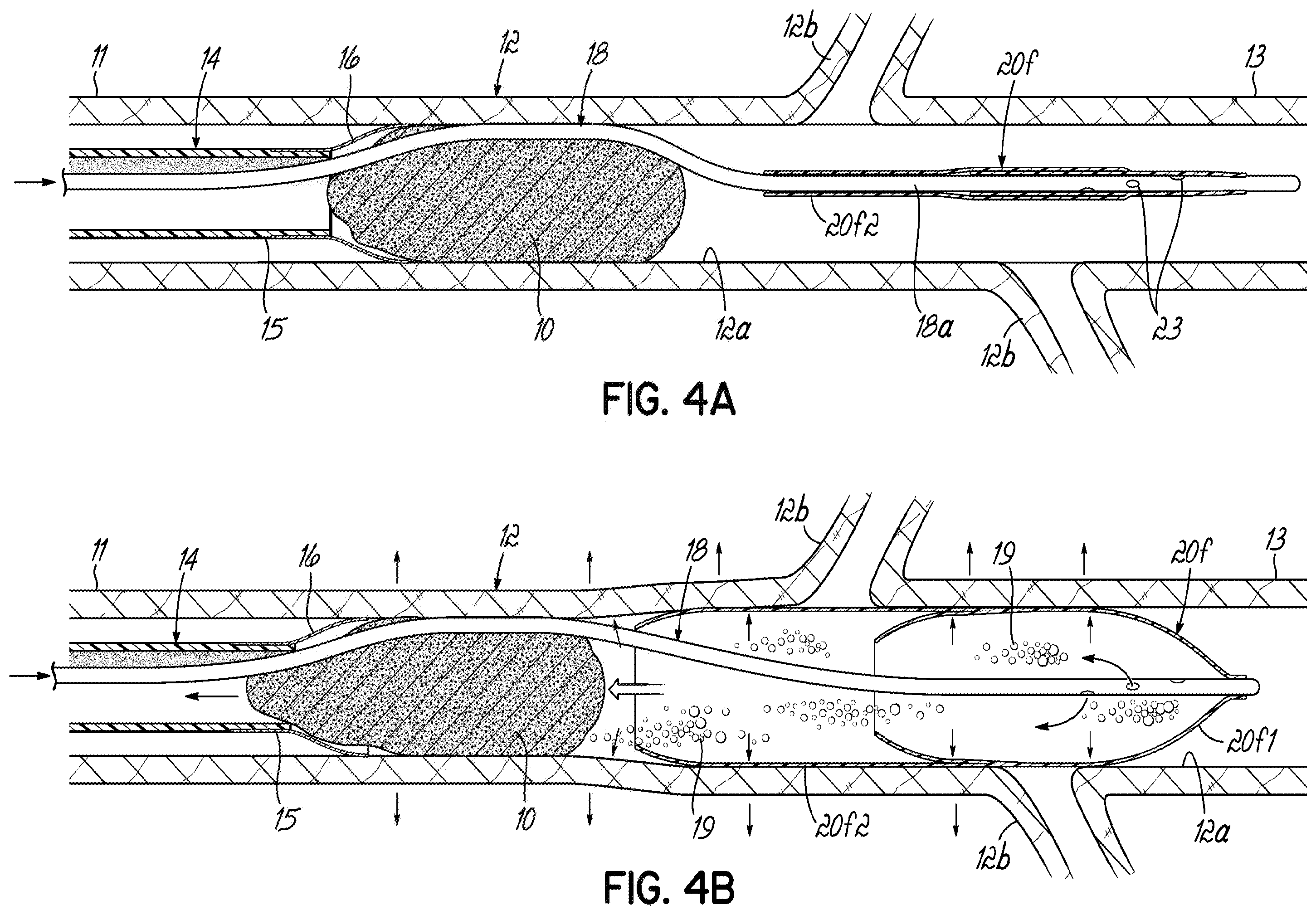 Patent US11793532 Figure 11 – Devices, systems and methods to remove blood clots