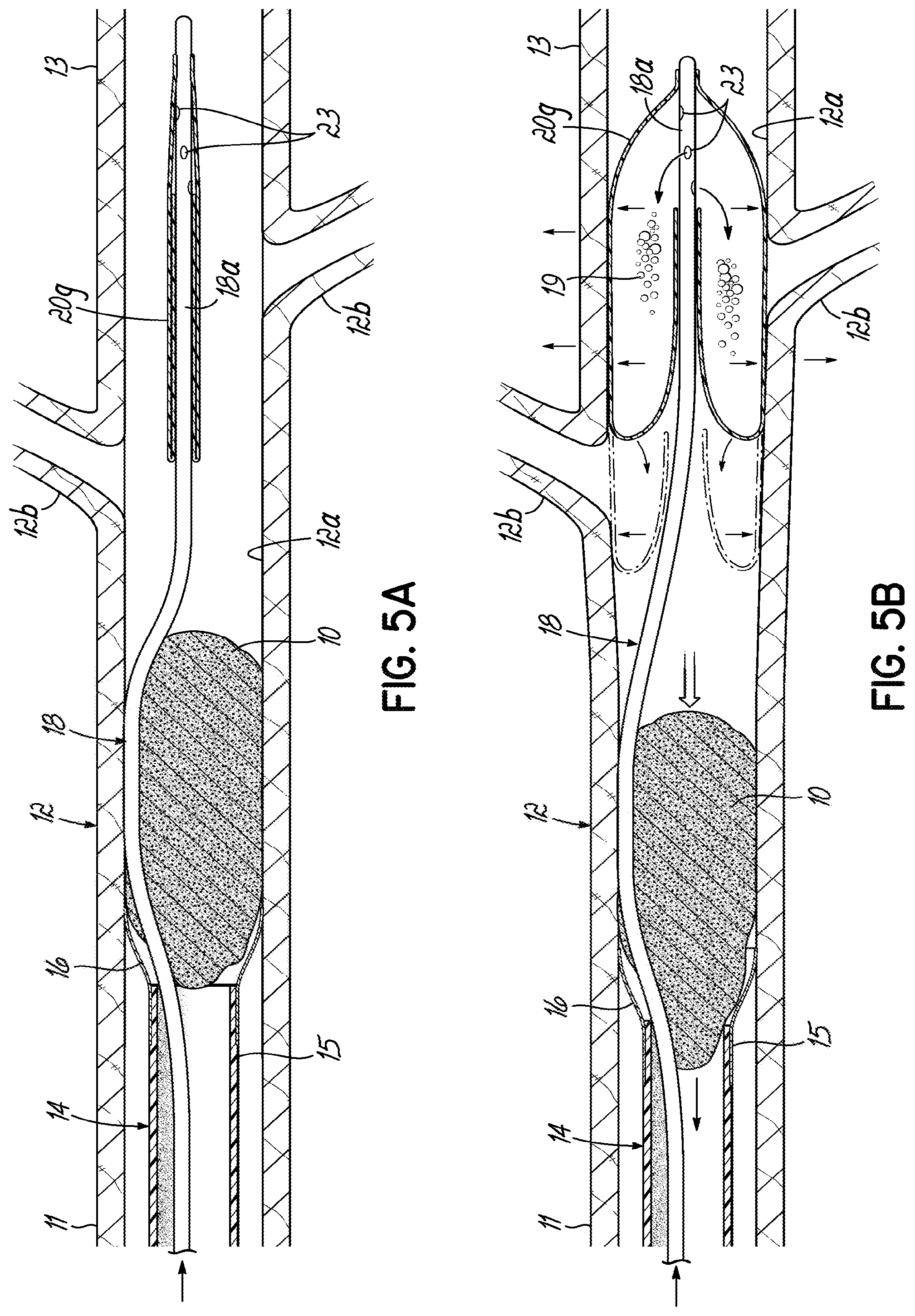 Patent US11793532 Figure 12 – Devices, systems and methods to remove blood clots