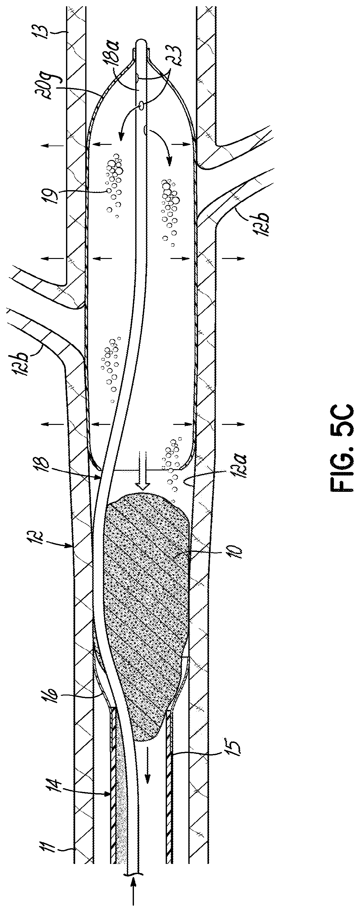 Patent US11793532 Figure 13 – Devices, systems and methods to remove blood clots