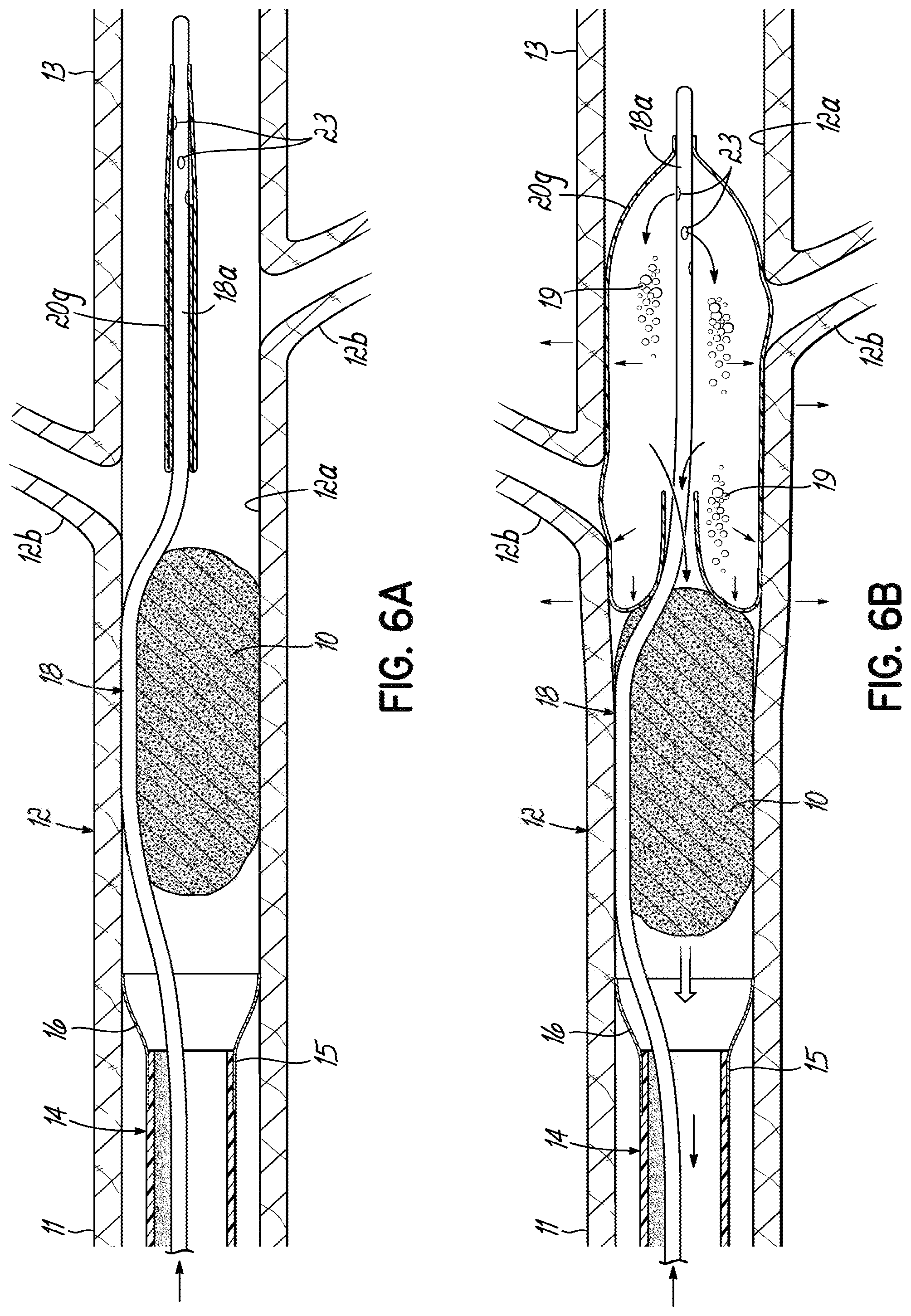 Patent US11793532 Figure 14 – Devices, systems and methods to remove blood clots