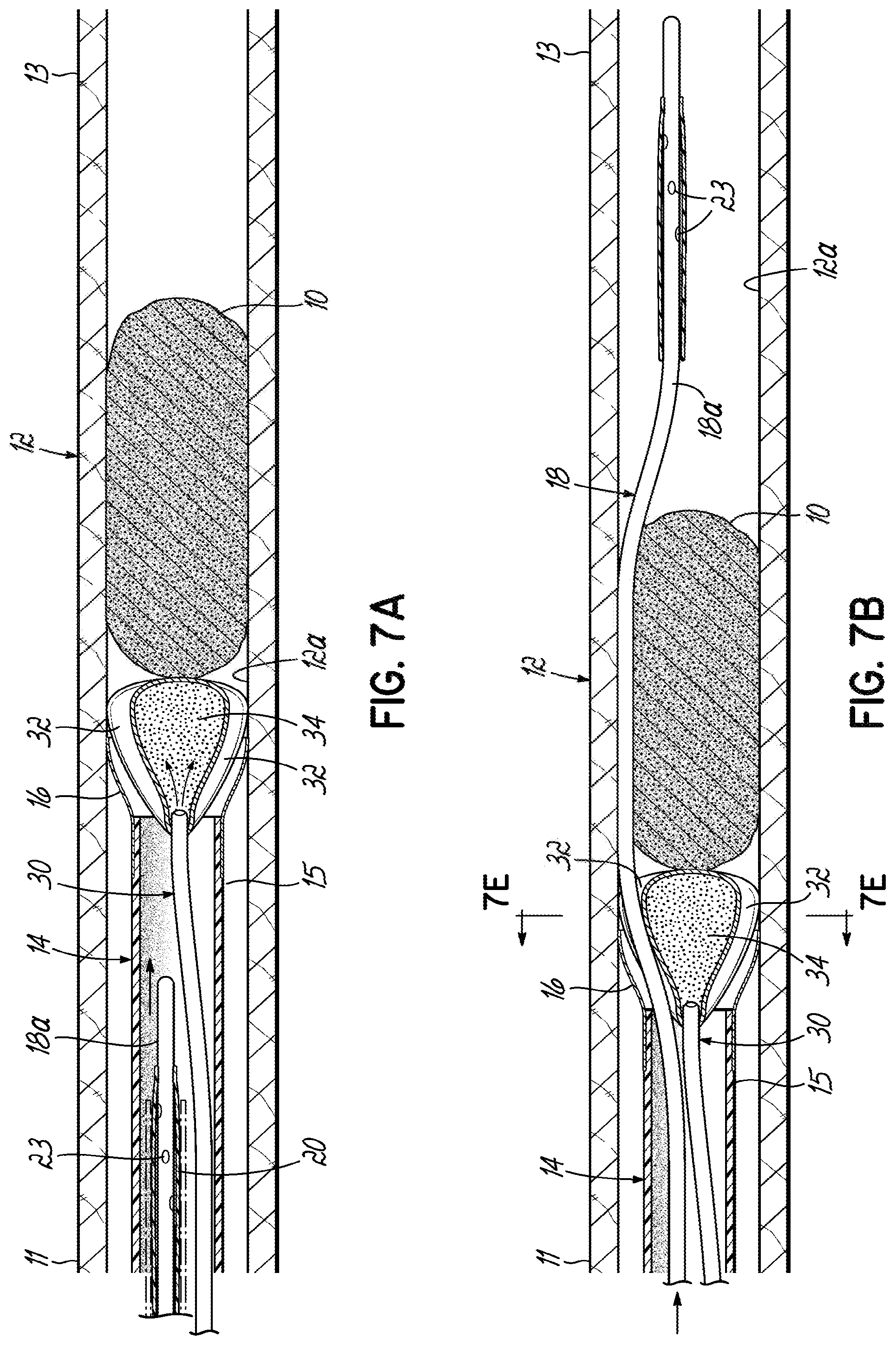 Patent US11793532 Figure 15 – Devices, systems and methods to remove blood clots