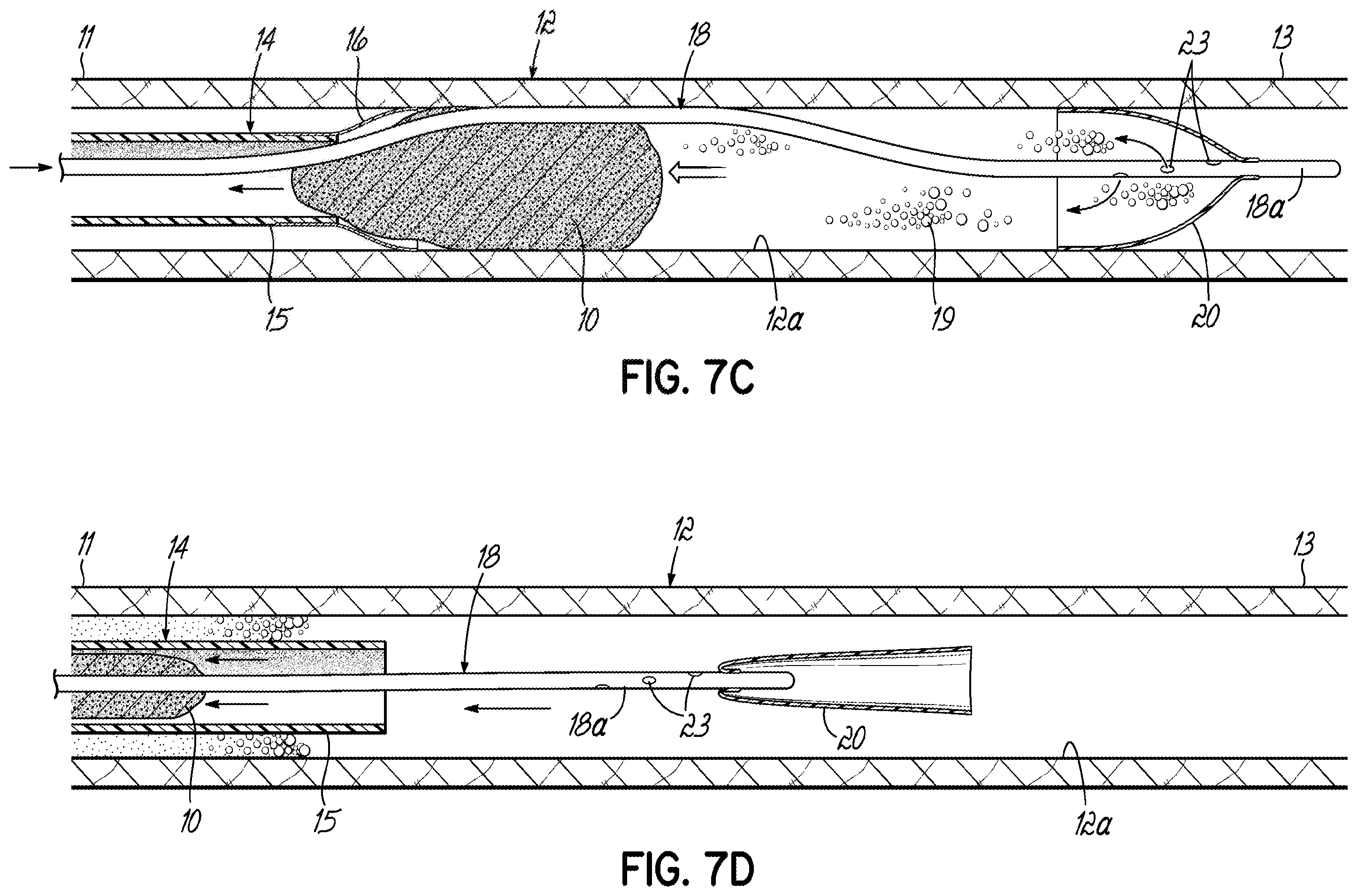 Patent US11793532 Figure 16 – Devices, systems and methods to remove blood clots