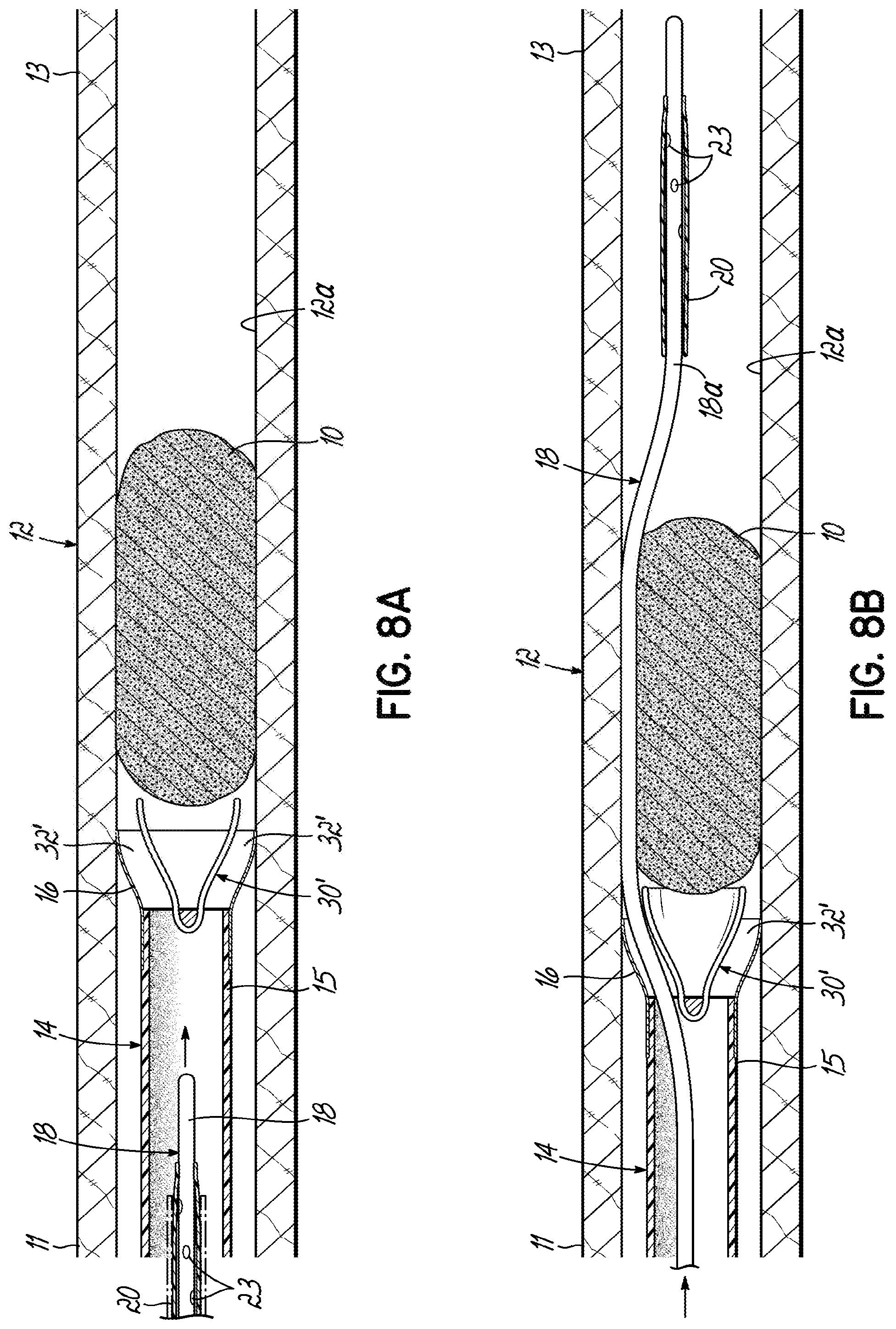 Patent US11793532 Figure 18 – Devices, systems and methods to remove blood clots