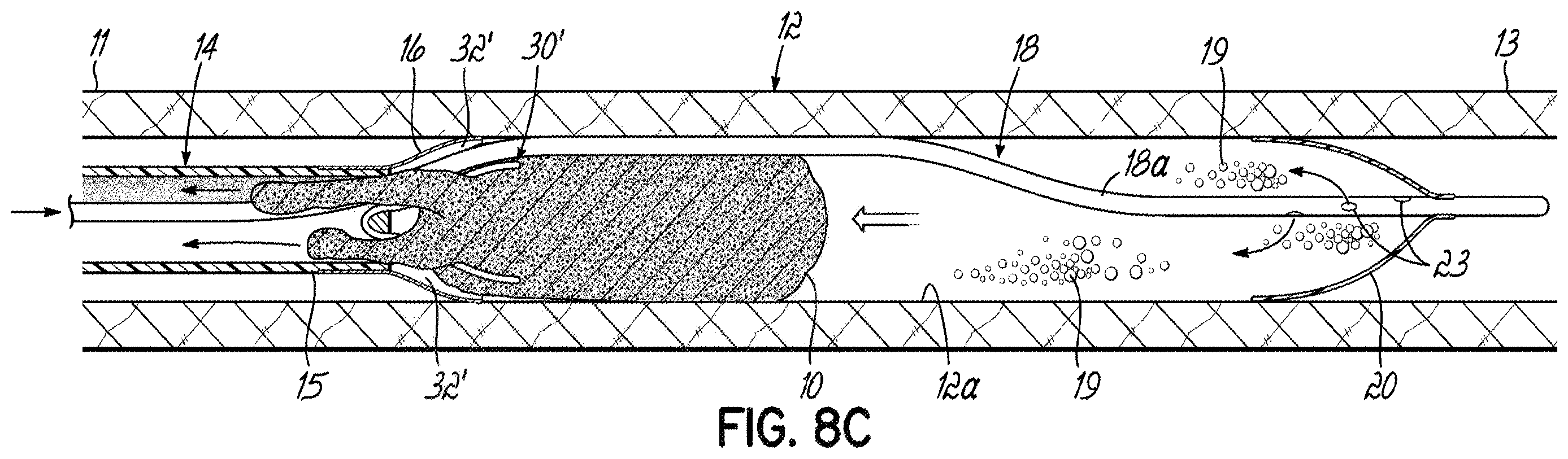 Patent US11793532 Figure 19 – Devices, systems and methods to remove blood clots