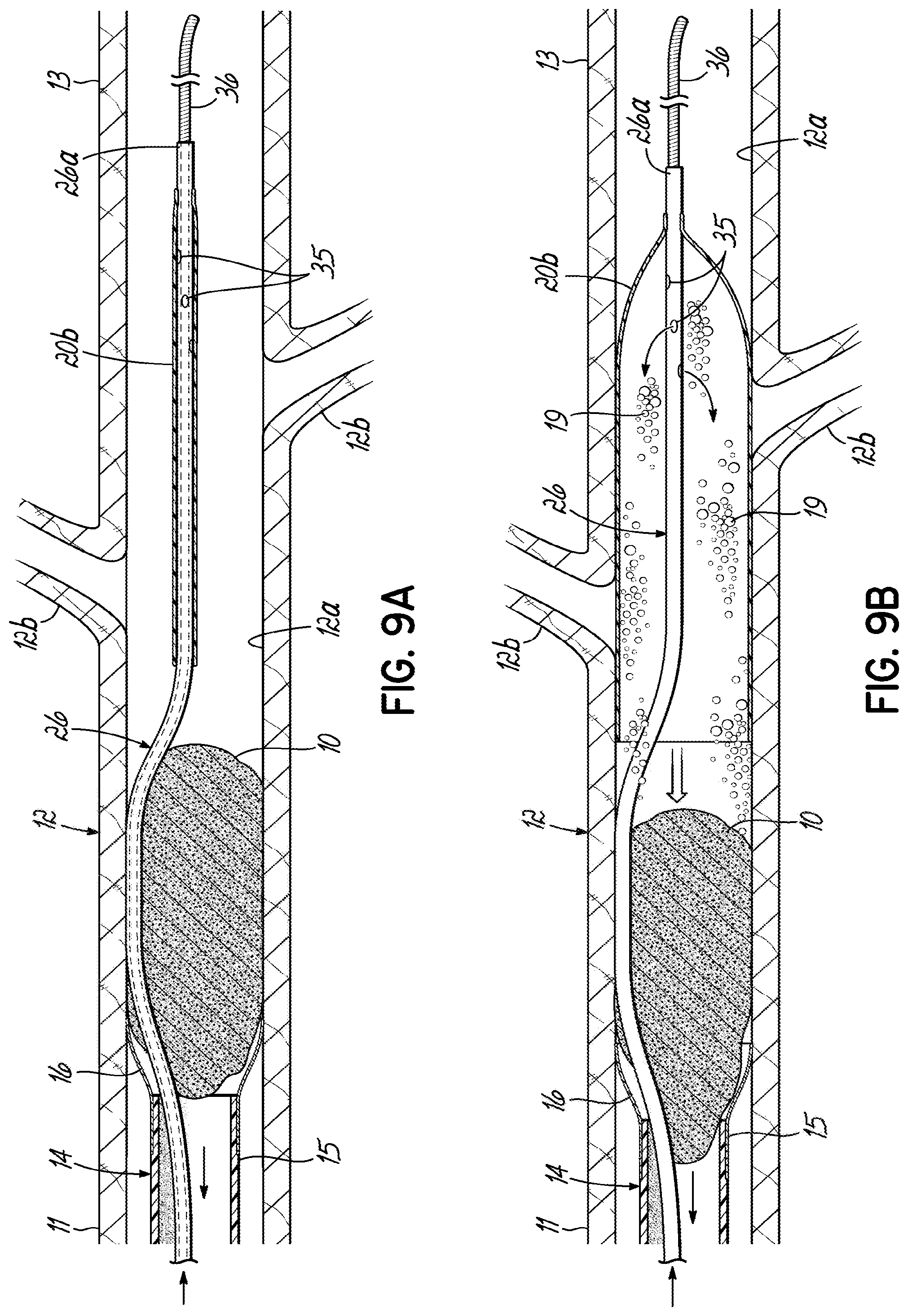 Patent US11793532 Figure 20 – Devices, systems and methods to remove blood clots