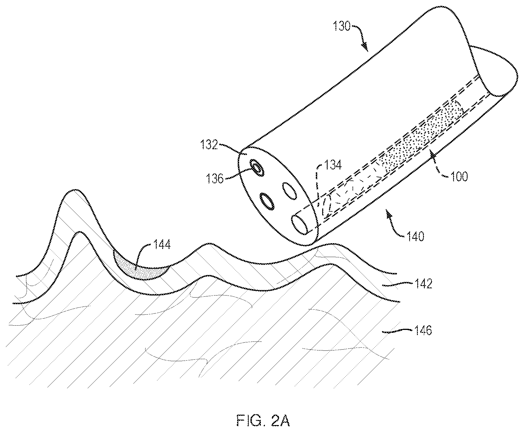 Patent US11793539 Figure 2 – Systems and methods for submucosal tissue separation